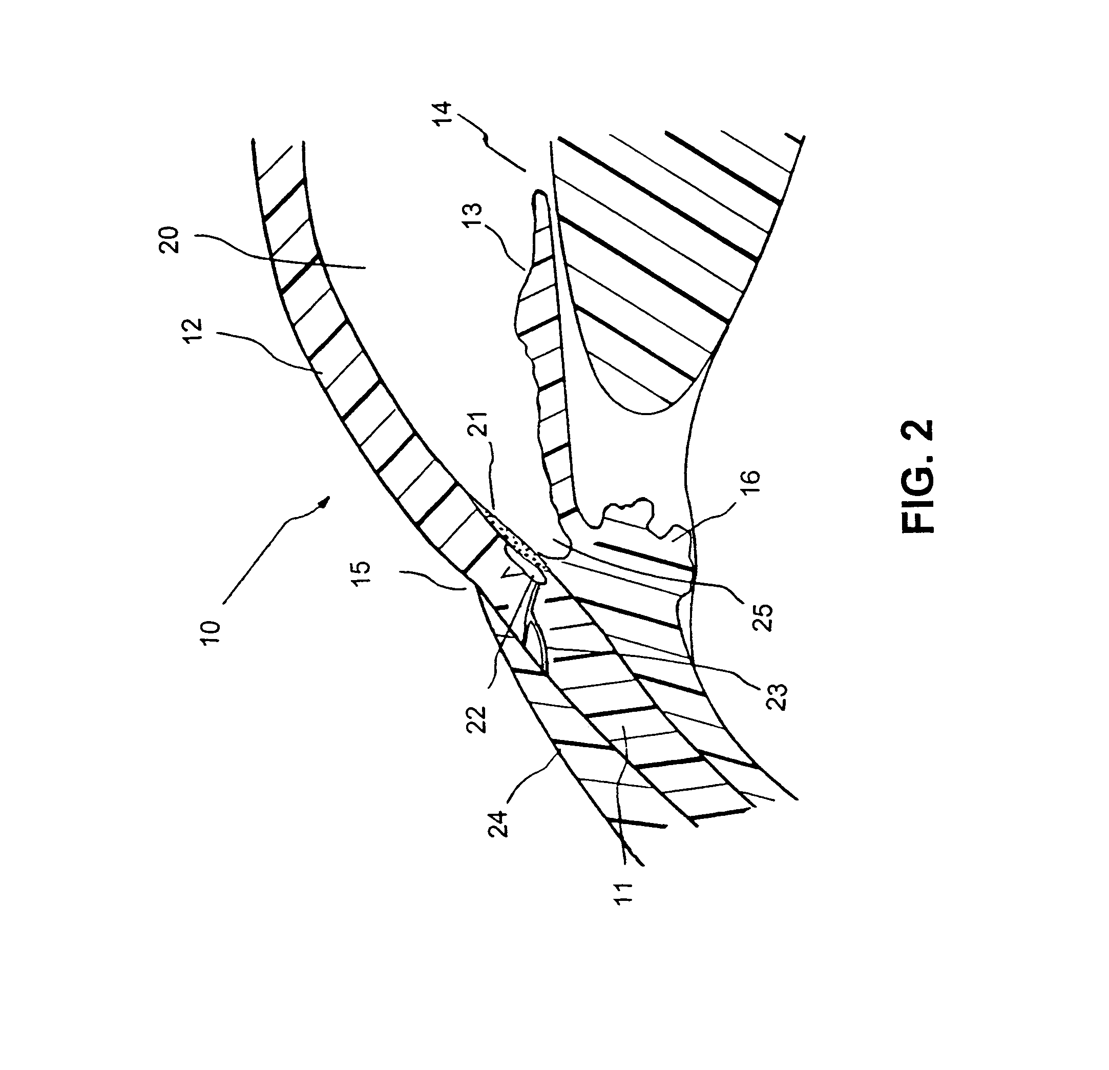 Implant with pressure sensor for glaucoma treatment