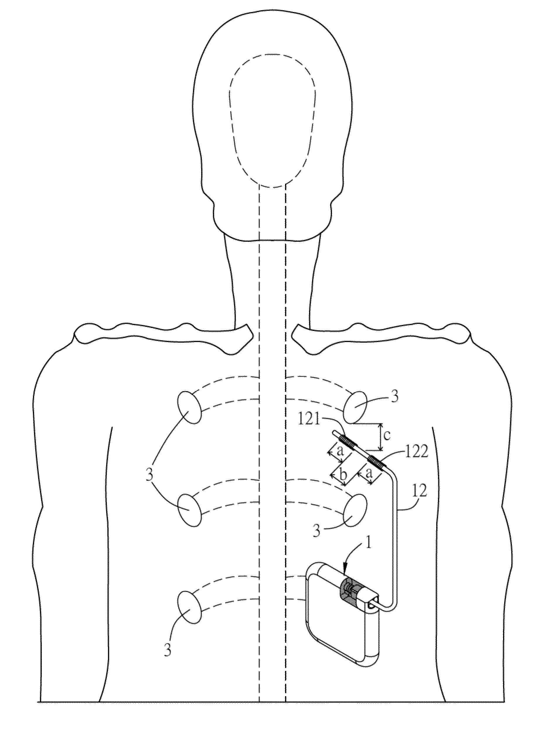 Electronic stimulation system and device thereof for  dorsal root ganglion