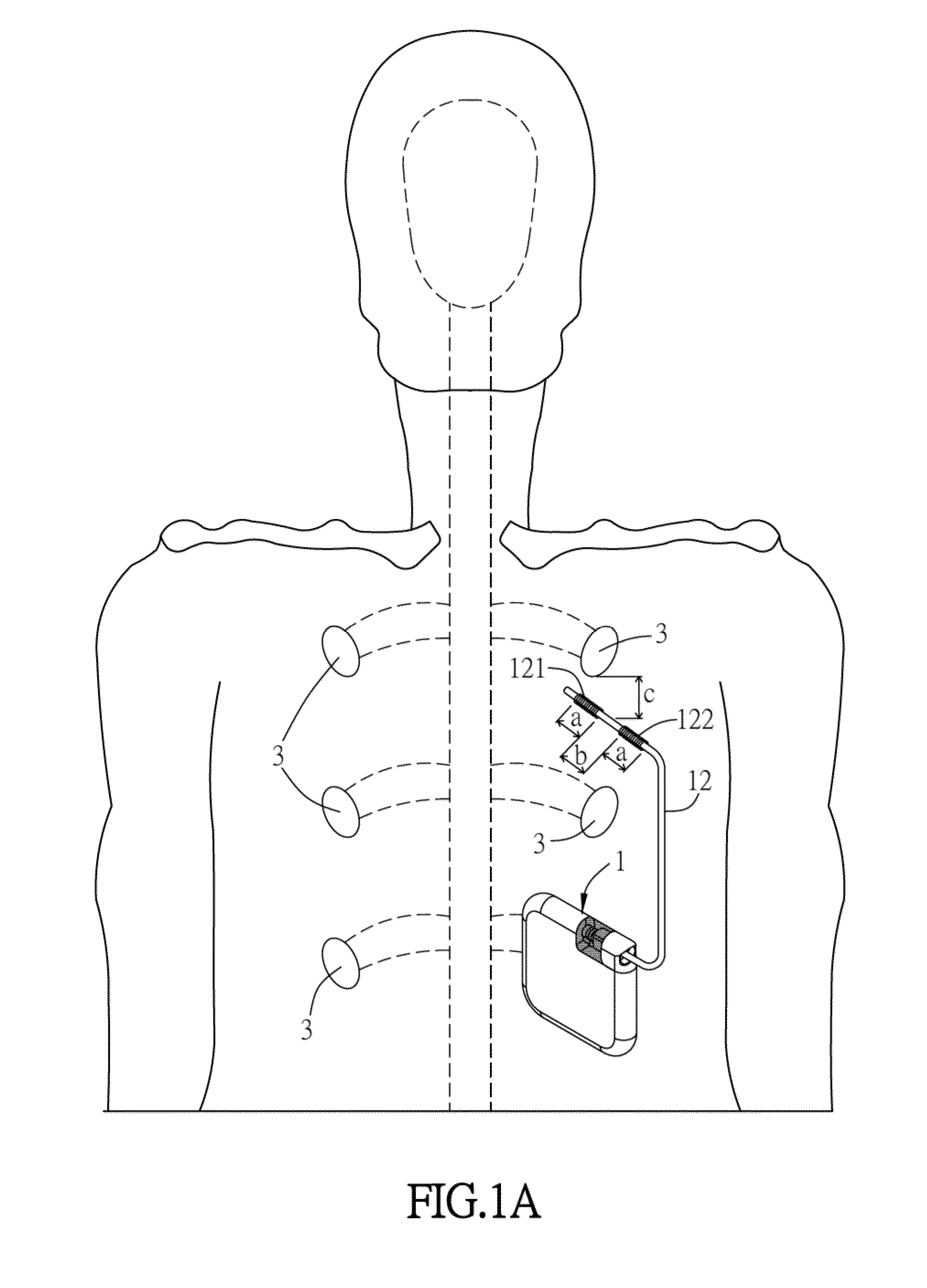 Electronic stimulation system and device thereof for  dorsal root ganglion