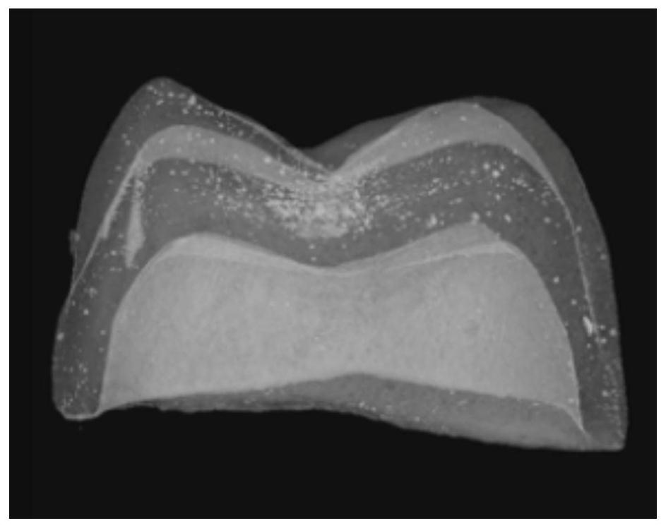 Detection method for internal defects of zirconia double-layer all-ceramic restorations