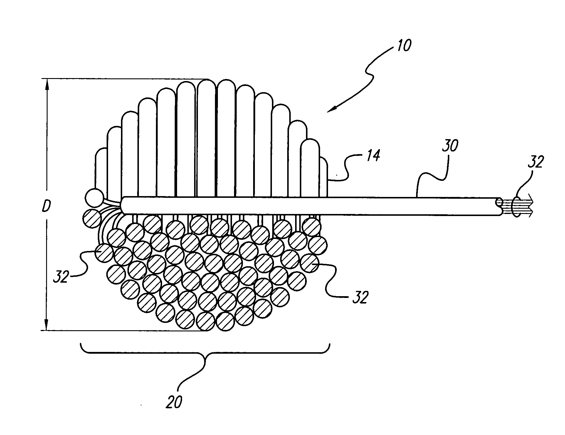 Soft, middle-ear electrode for suppressing tinnitis
