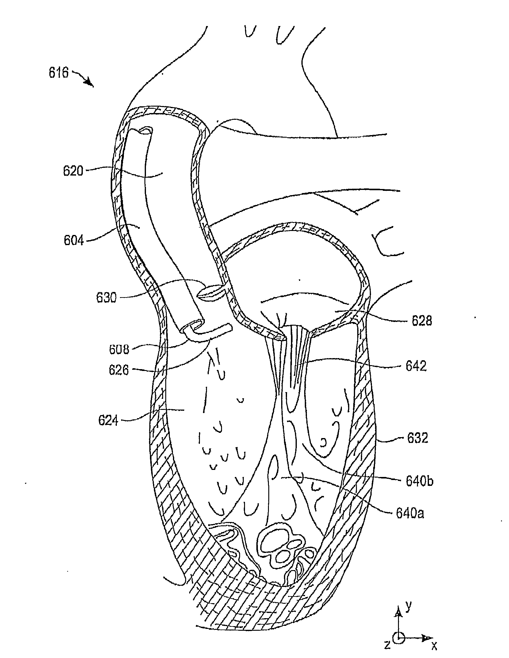Catheter-based annuloplasty using ventricularly positioned catheter