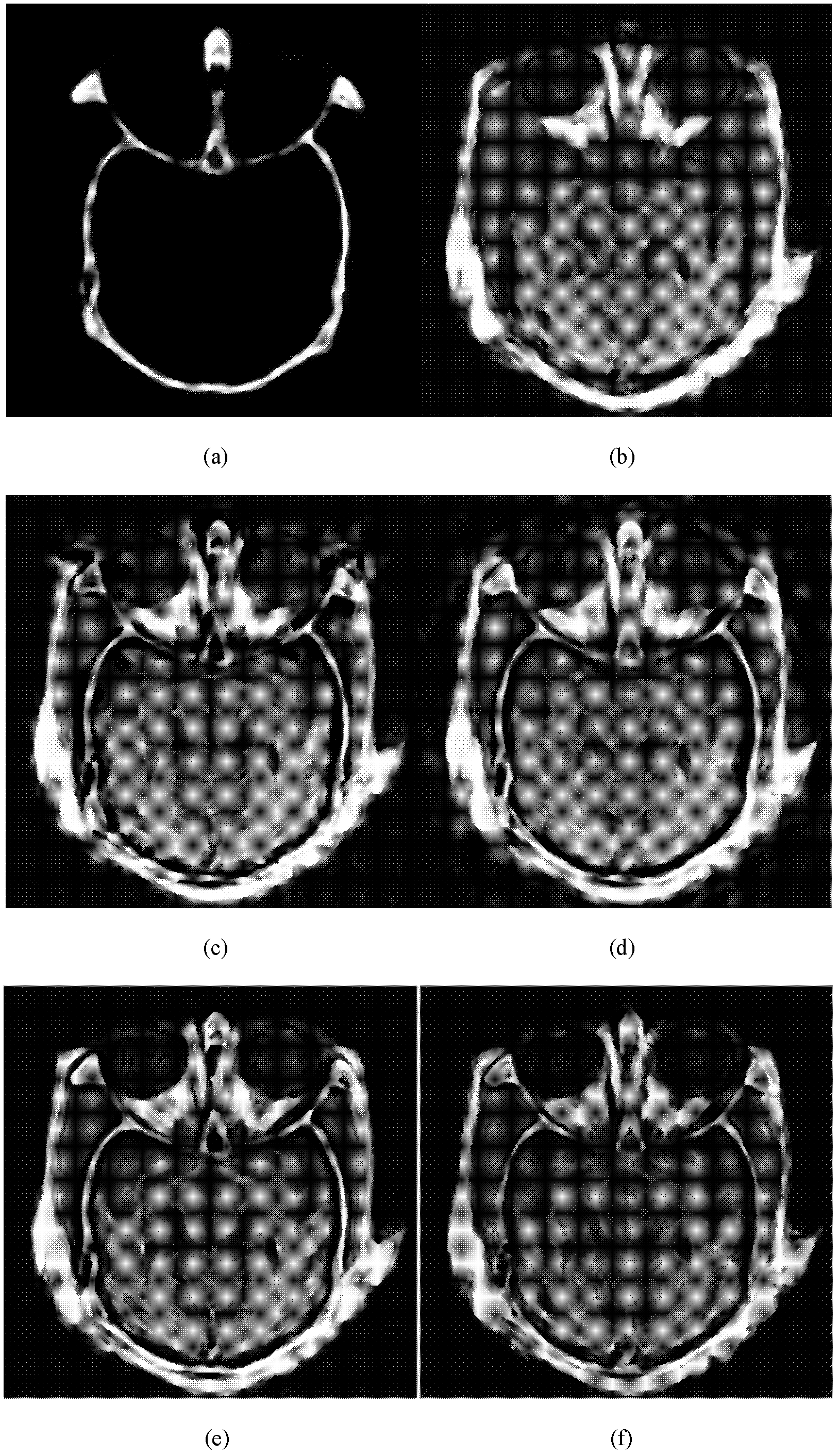 Medical image fusion method based on multidirectional empirical mode decomposition