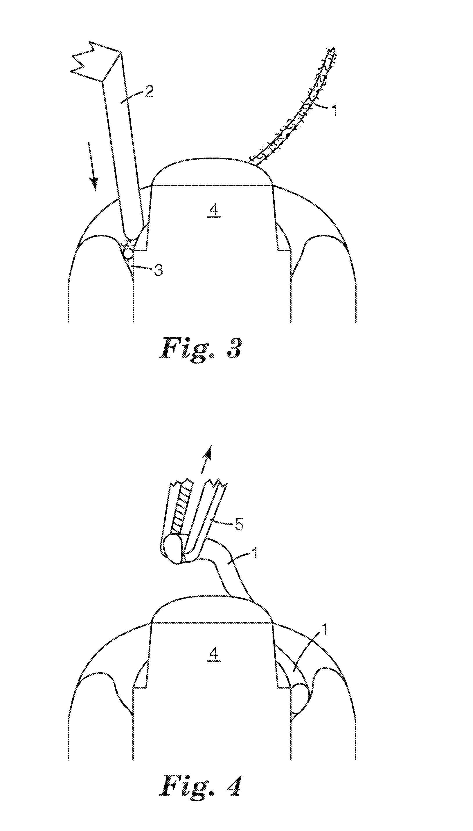 Dental Retraction Device and Process of its Production