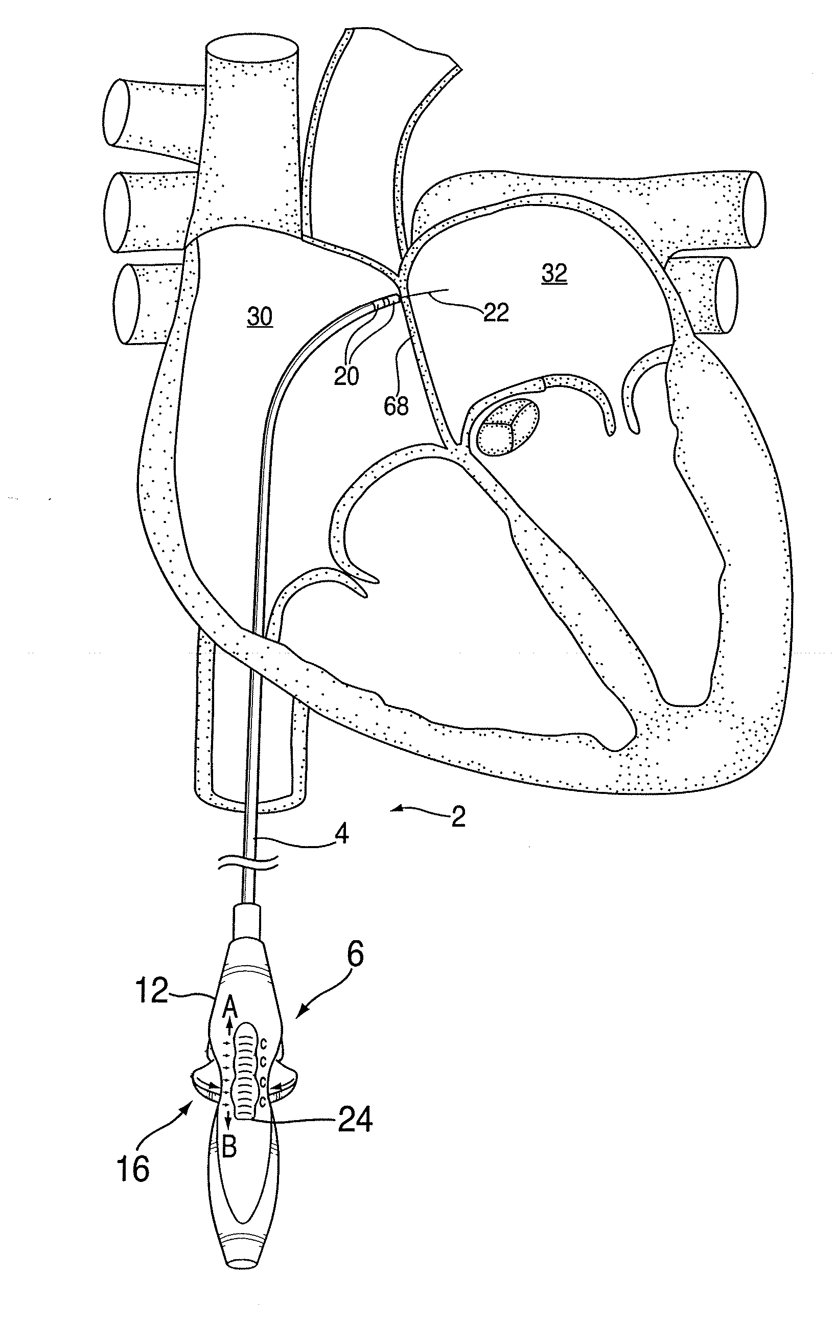 Apparatus for safe performance of transseptal technique and placement and positioning of an ablation catheter