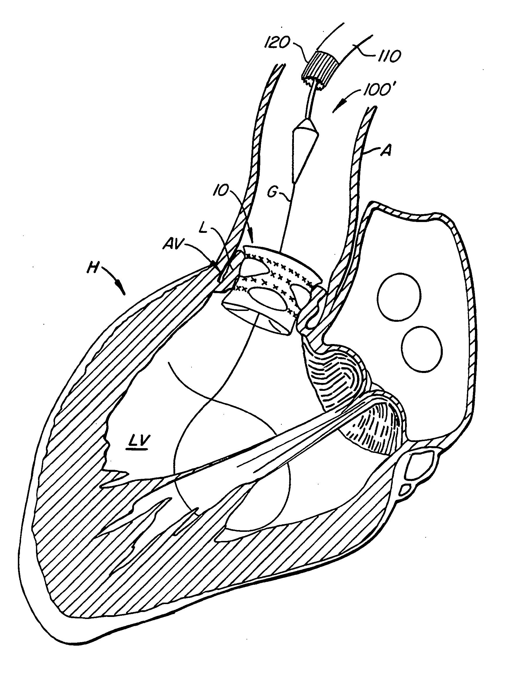 Heart valve anchor and method
