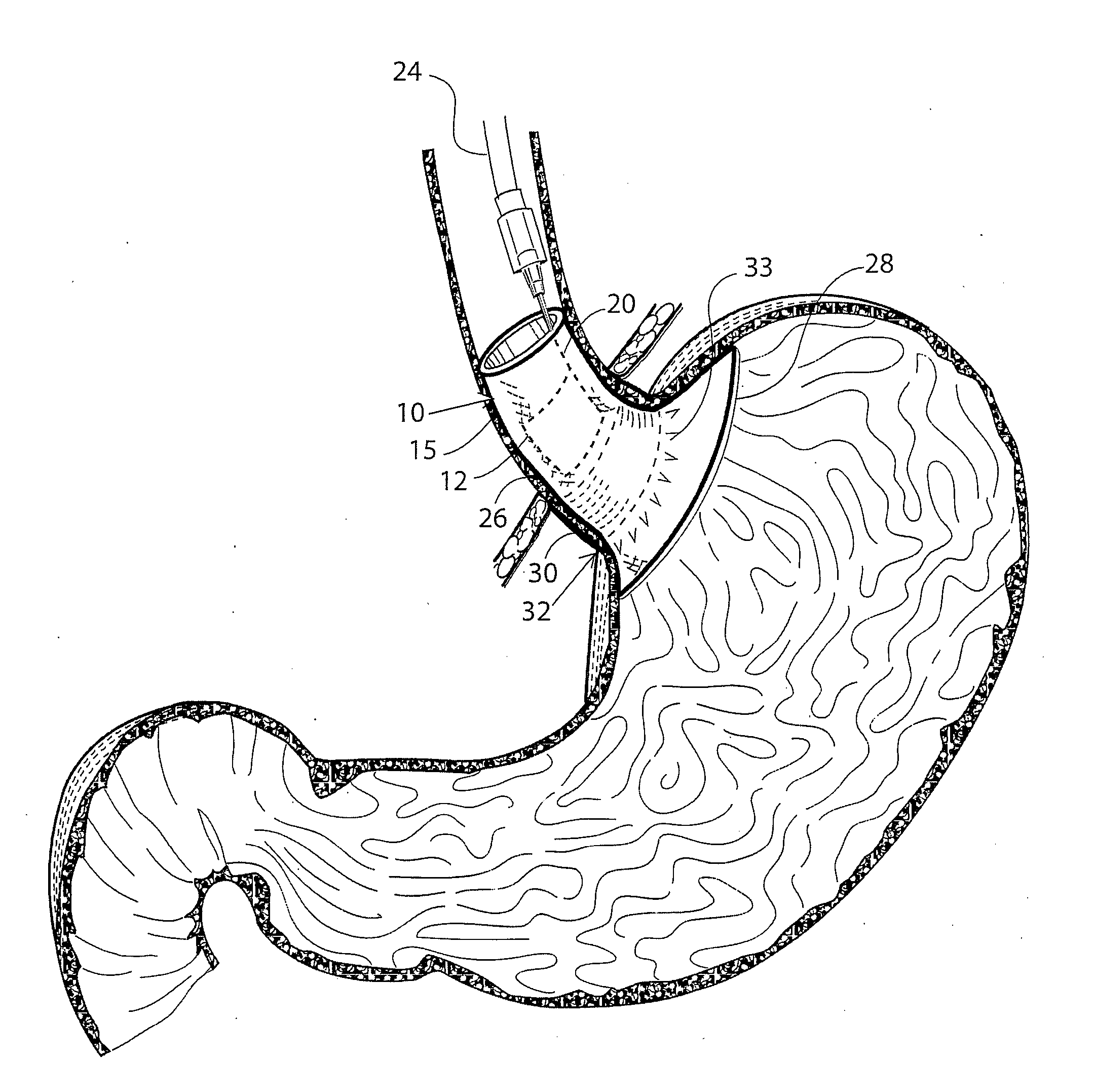 Medical agent delivery system and method