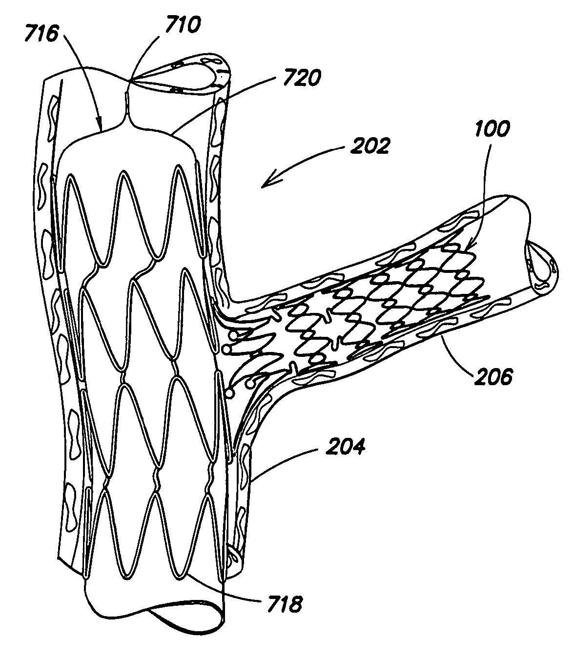 Segmented ostial protection device