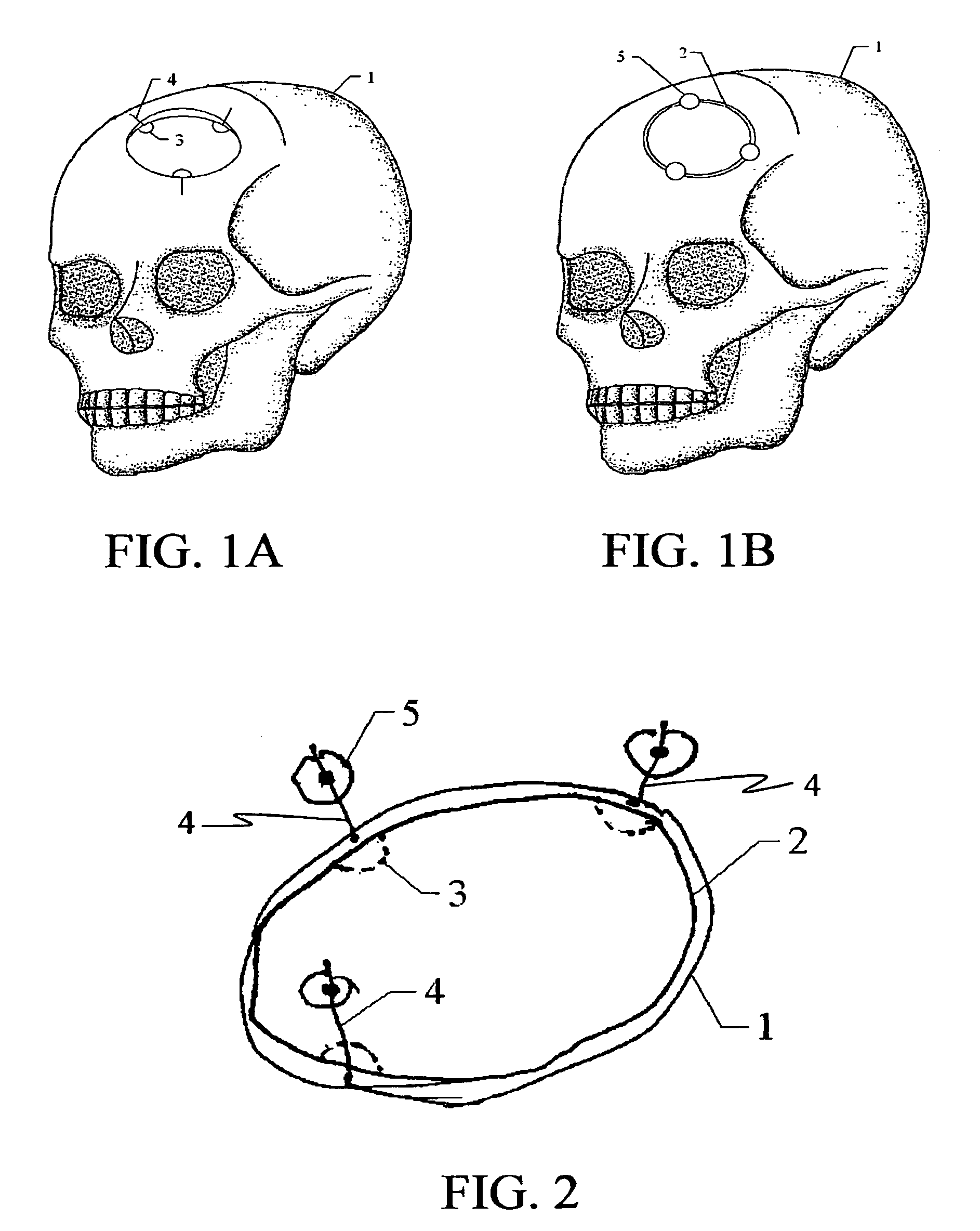 Closure device for skull plates and related method thereof