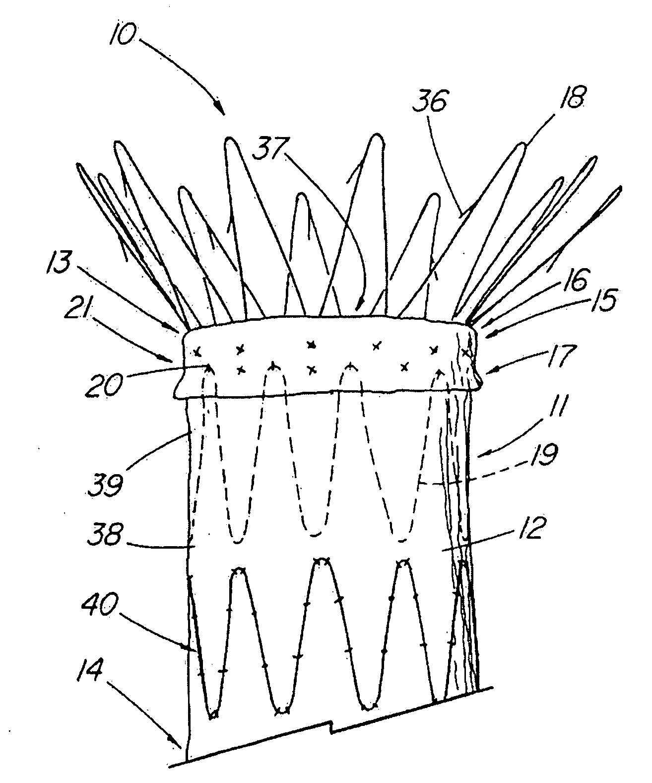 Endoluminal device with extracellular matrix material and methods