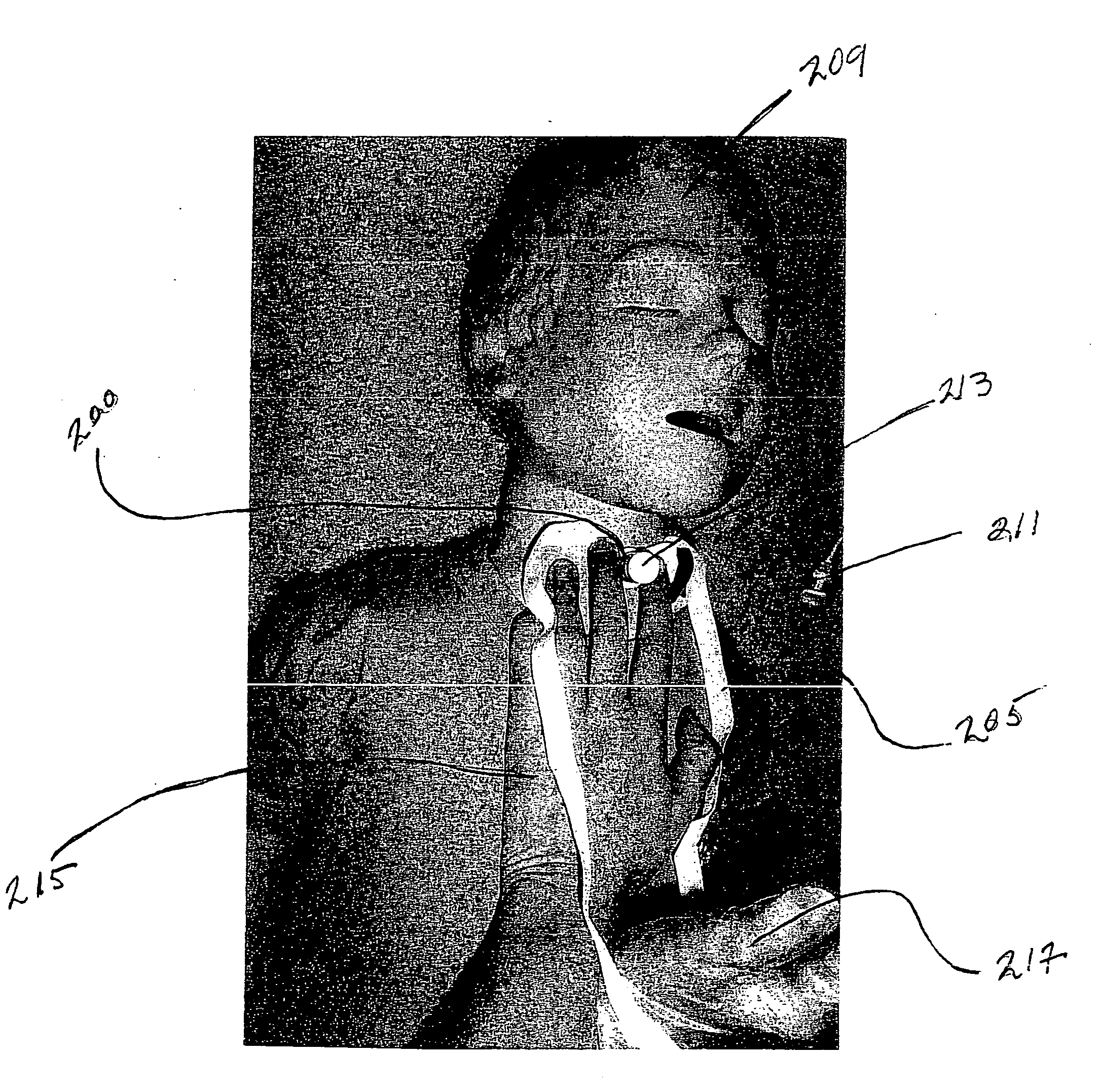 tracheostomy-tube-with-improved-tie-and-method-holding-same-eureka