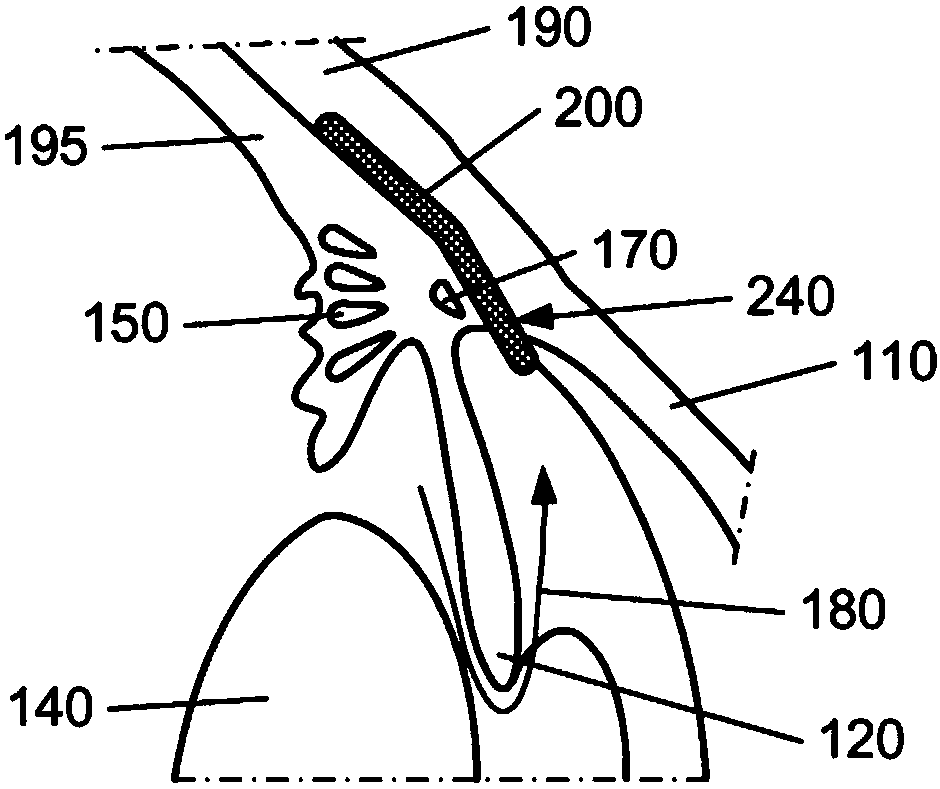 Ocular implant system