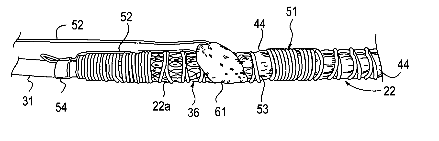 Apparatus with visual marker for guiding deployment of implantable prosthesis