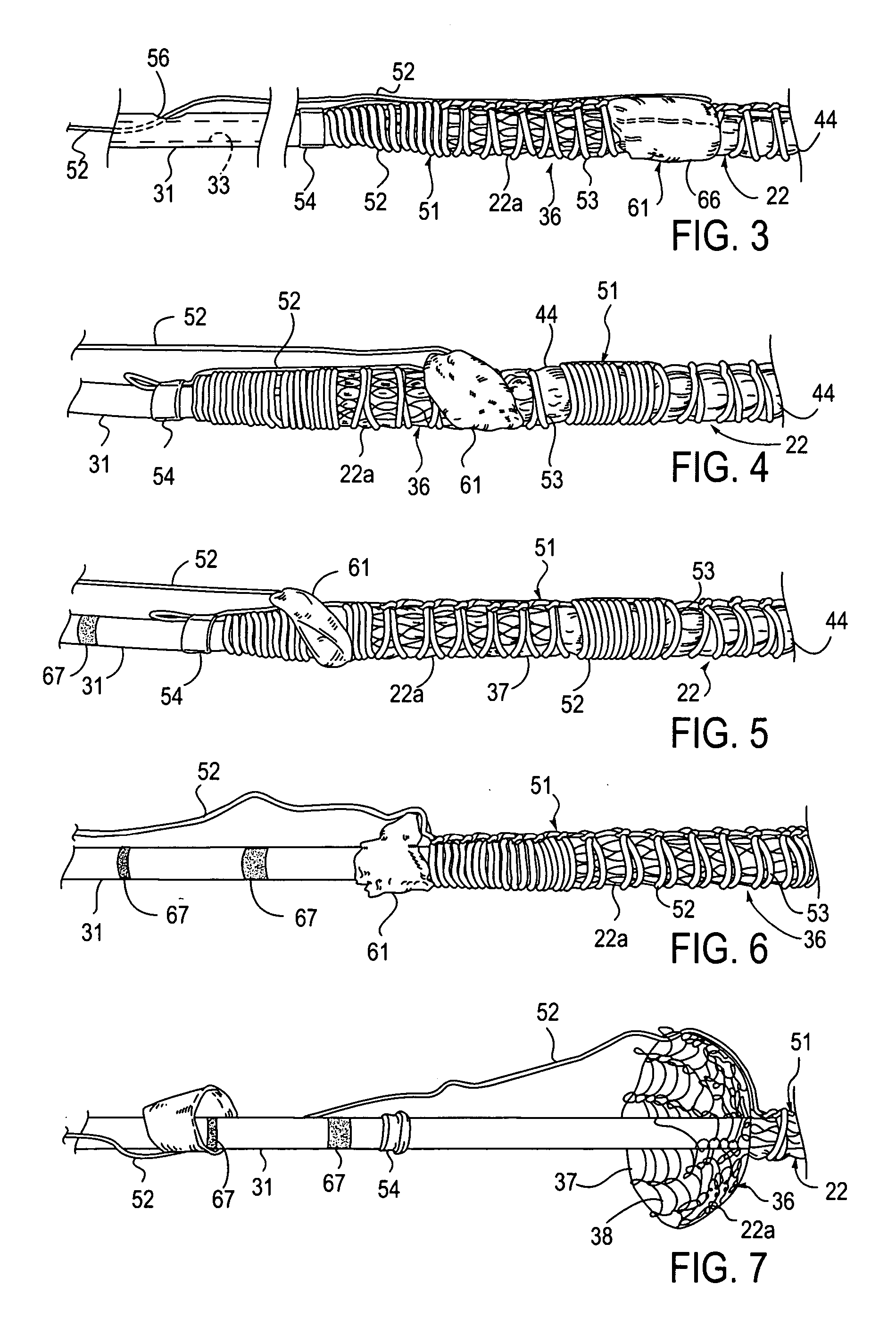 Apparatus with visual marker for guiding deployment of implantable prosthesis