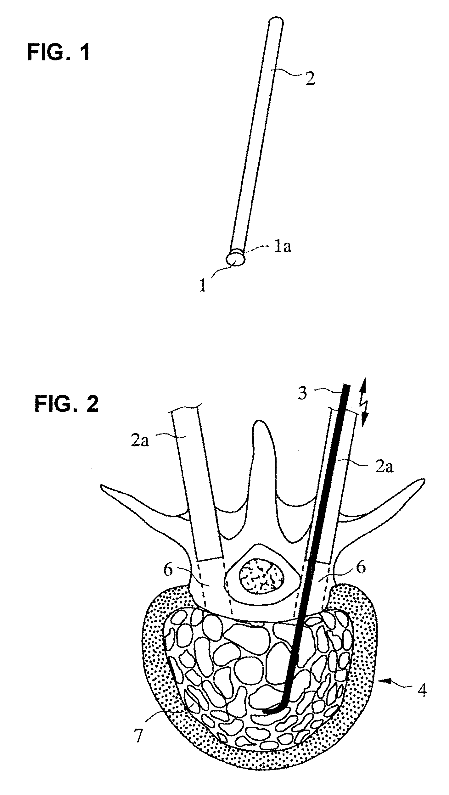 Bone cement injecting and filling method and leakage prevention bag for injecting and filling bone cement