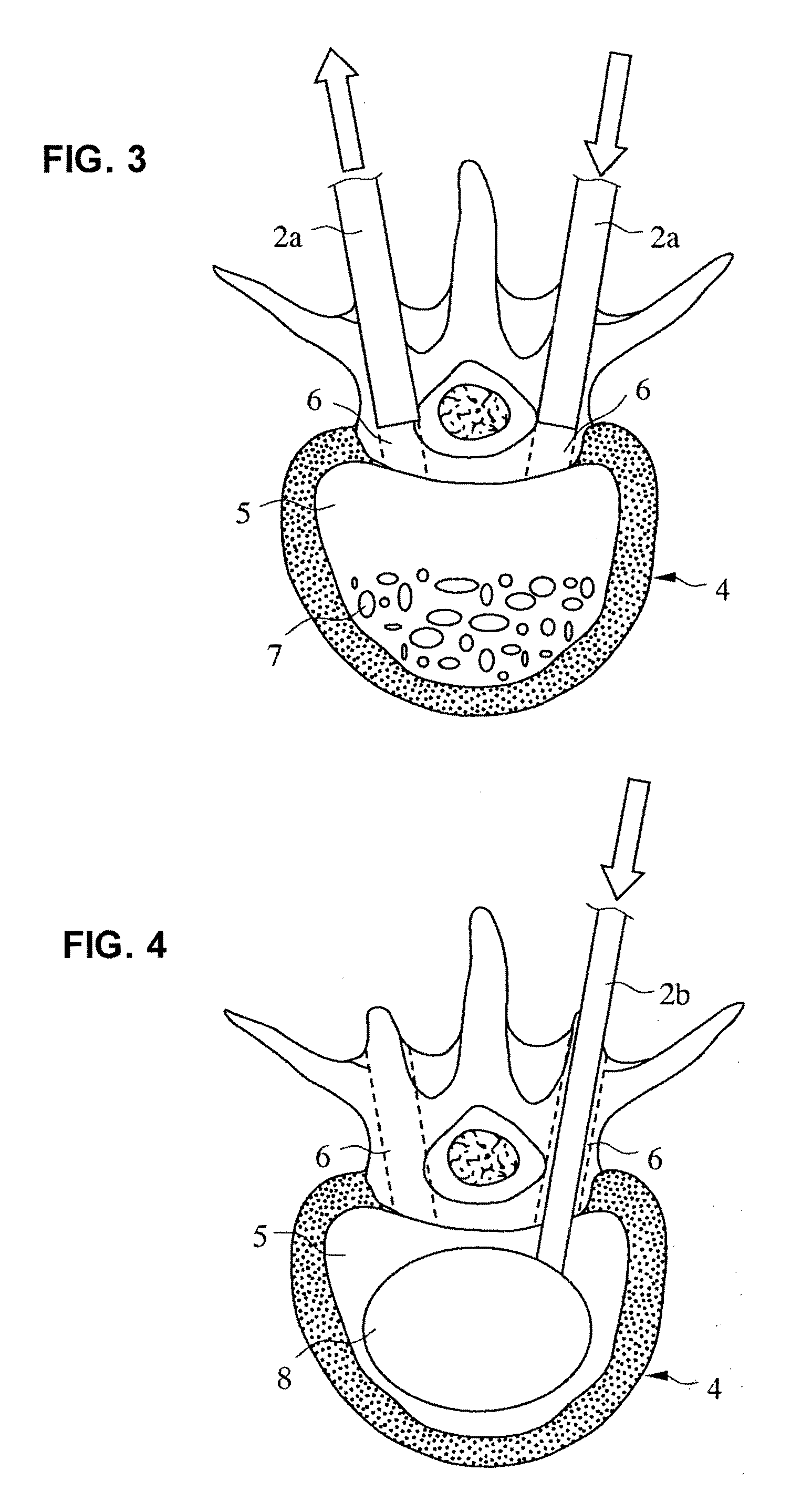 Bone cement injecting and filling method and leakage prevention bag for injecting and filling bone cement