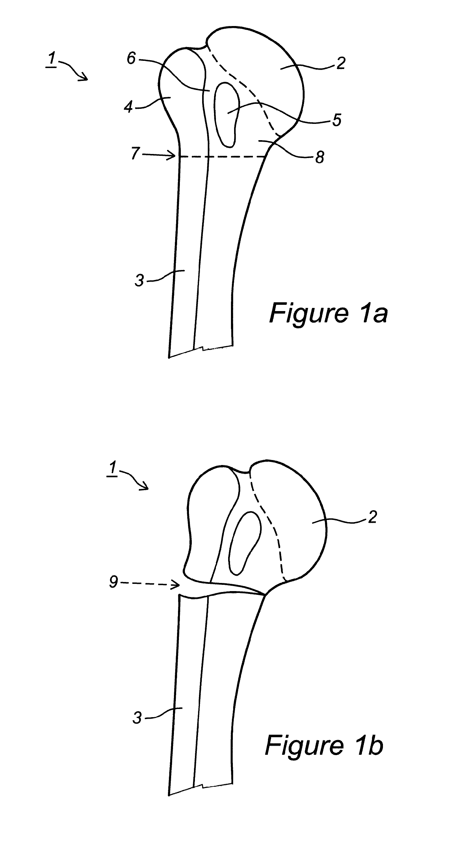 Articular fracture fixation system and method