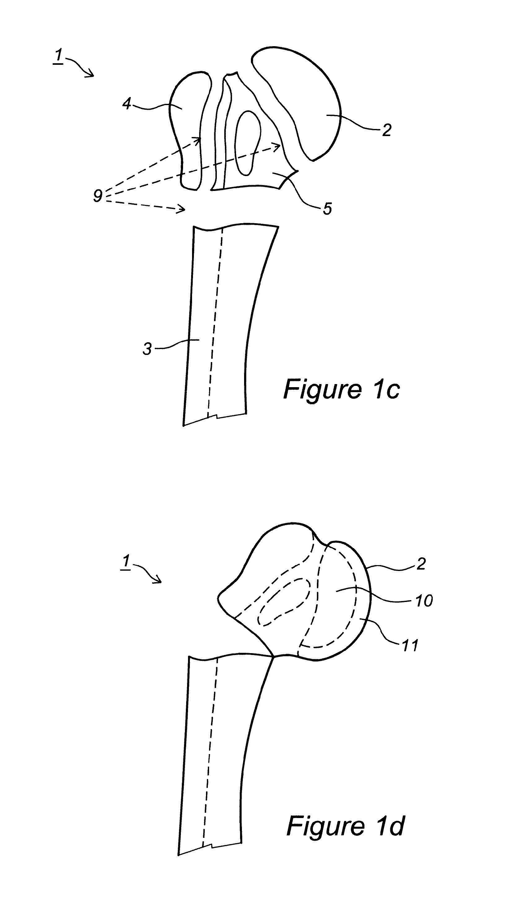 Articular fracture fixation system and method