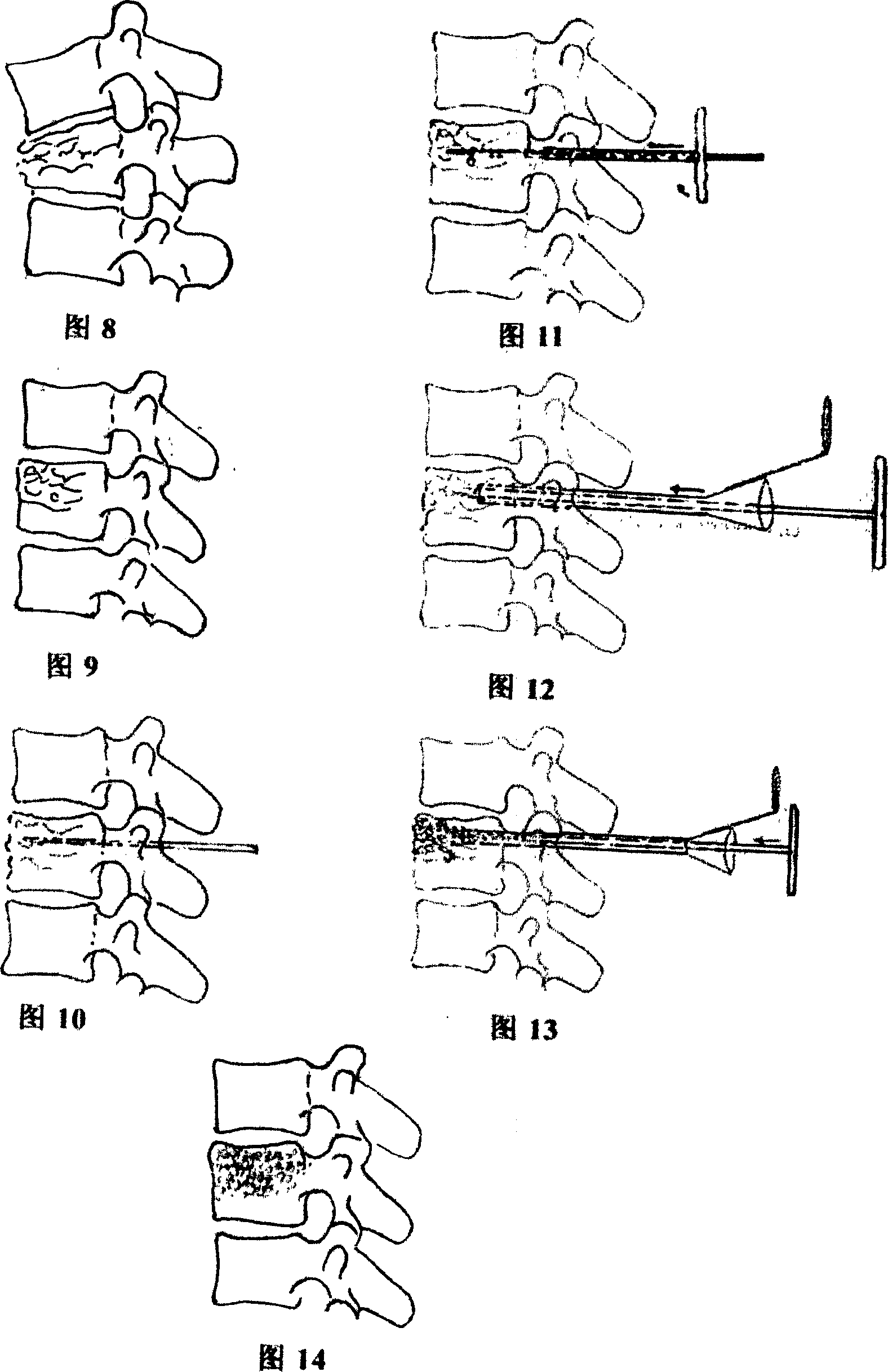 Trans-vertebral arch pedicle type hollow vertebra centrum bone-grafting apparatus