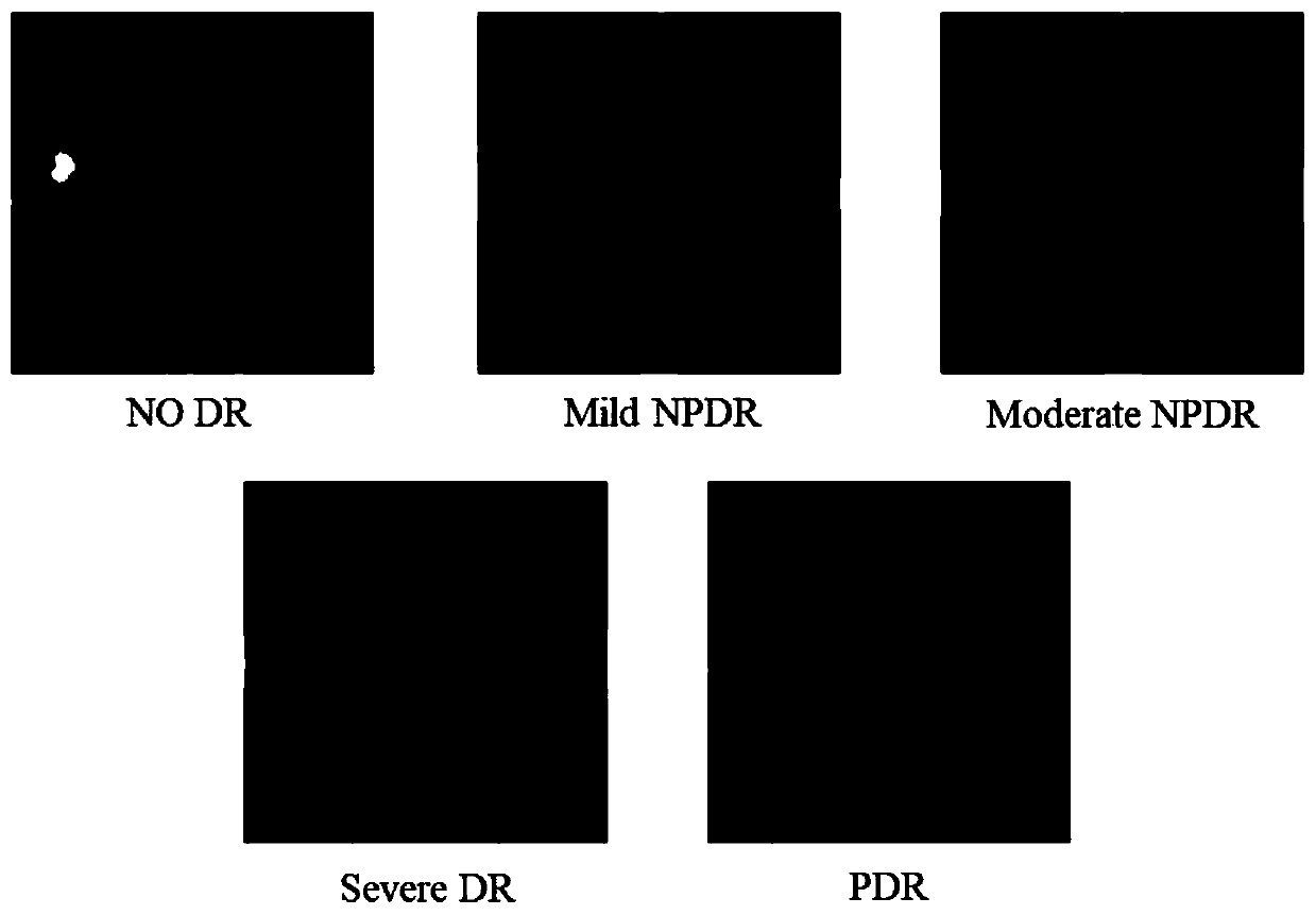Fundus image lesion degree identification and visualization system based on convolutional neural network