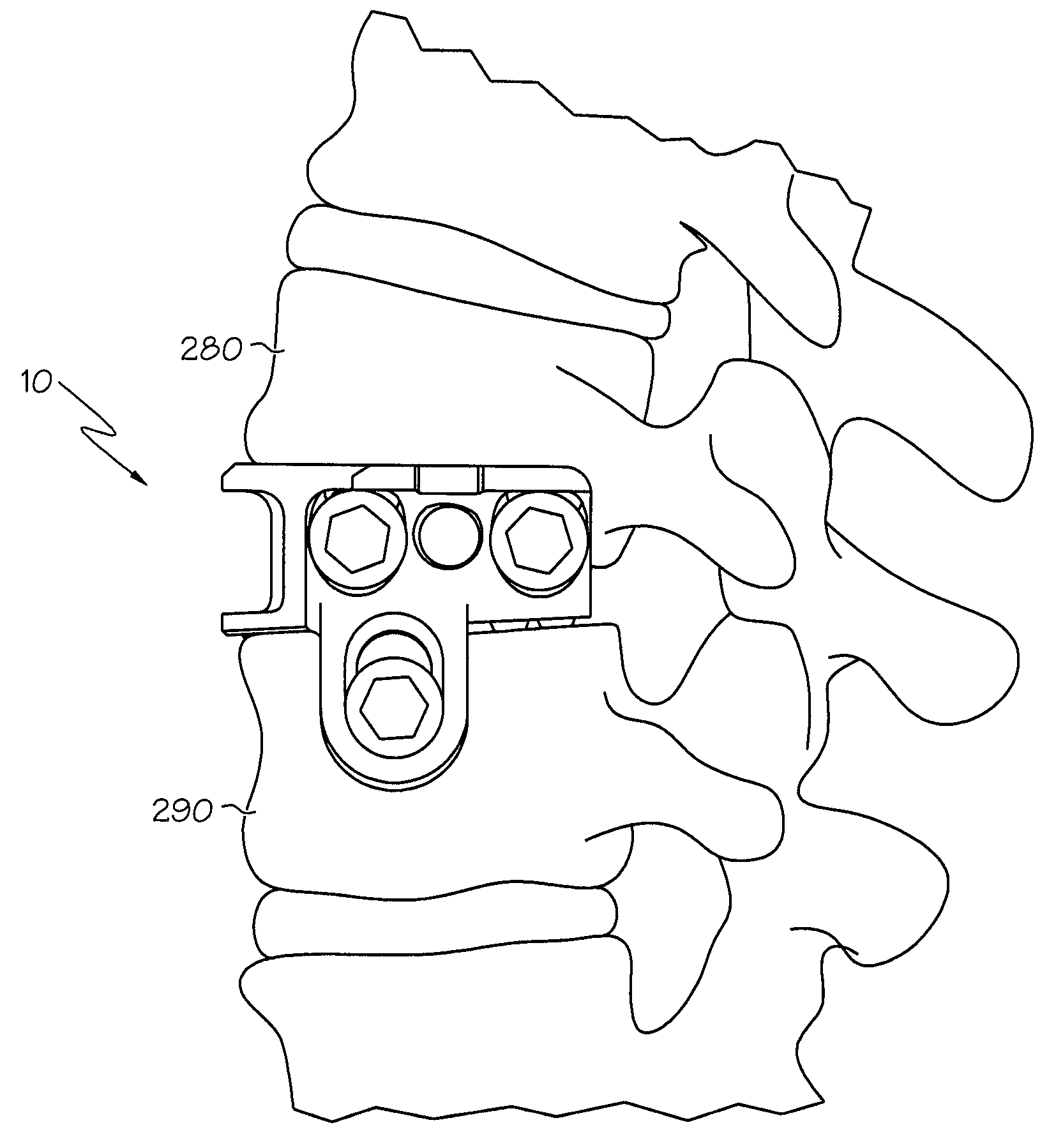 Lateral mount implant device