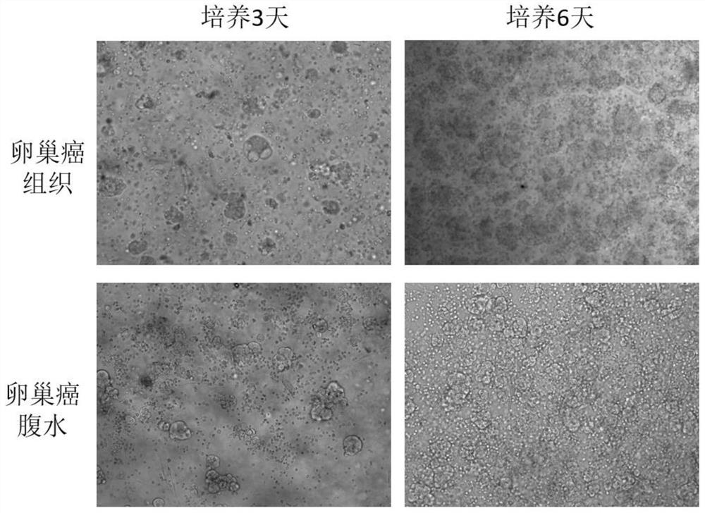 A kind of pleural and ascites organoid culture medium, culture method and drug susceptibility testing method