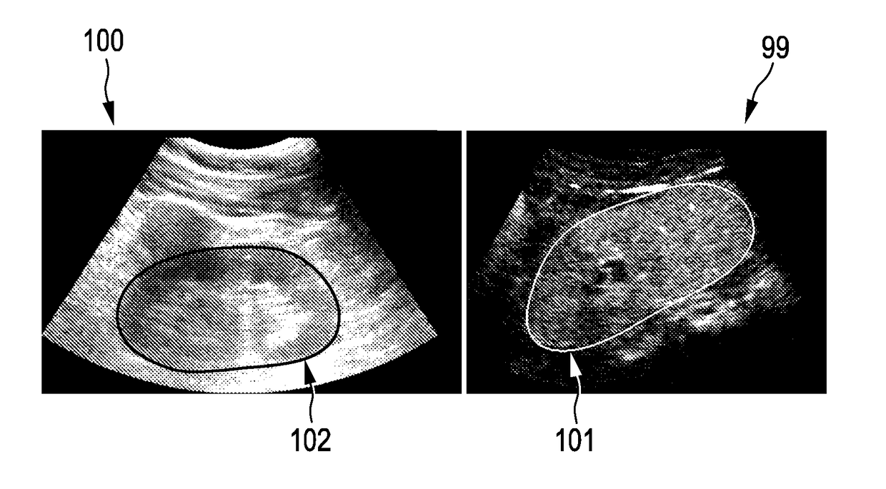 Coupled segmentation in 3D conventional ultrasound and contrast-enhanced ultrasound images