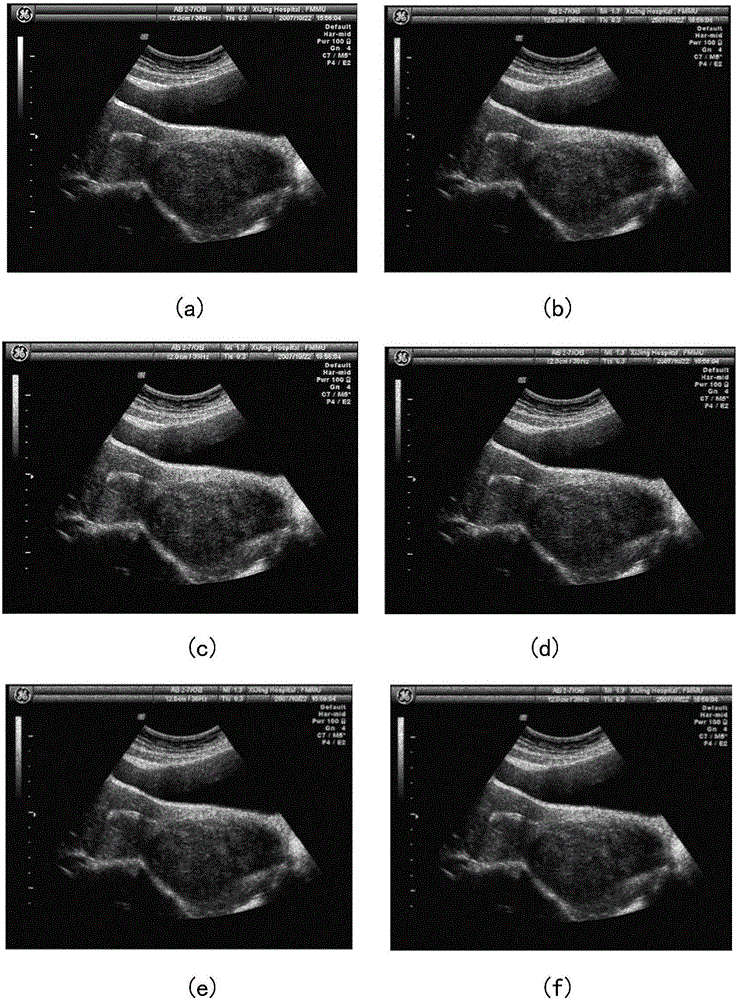 Human tissue focus detection method based on infrared thermal imaging technology