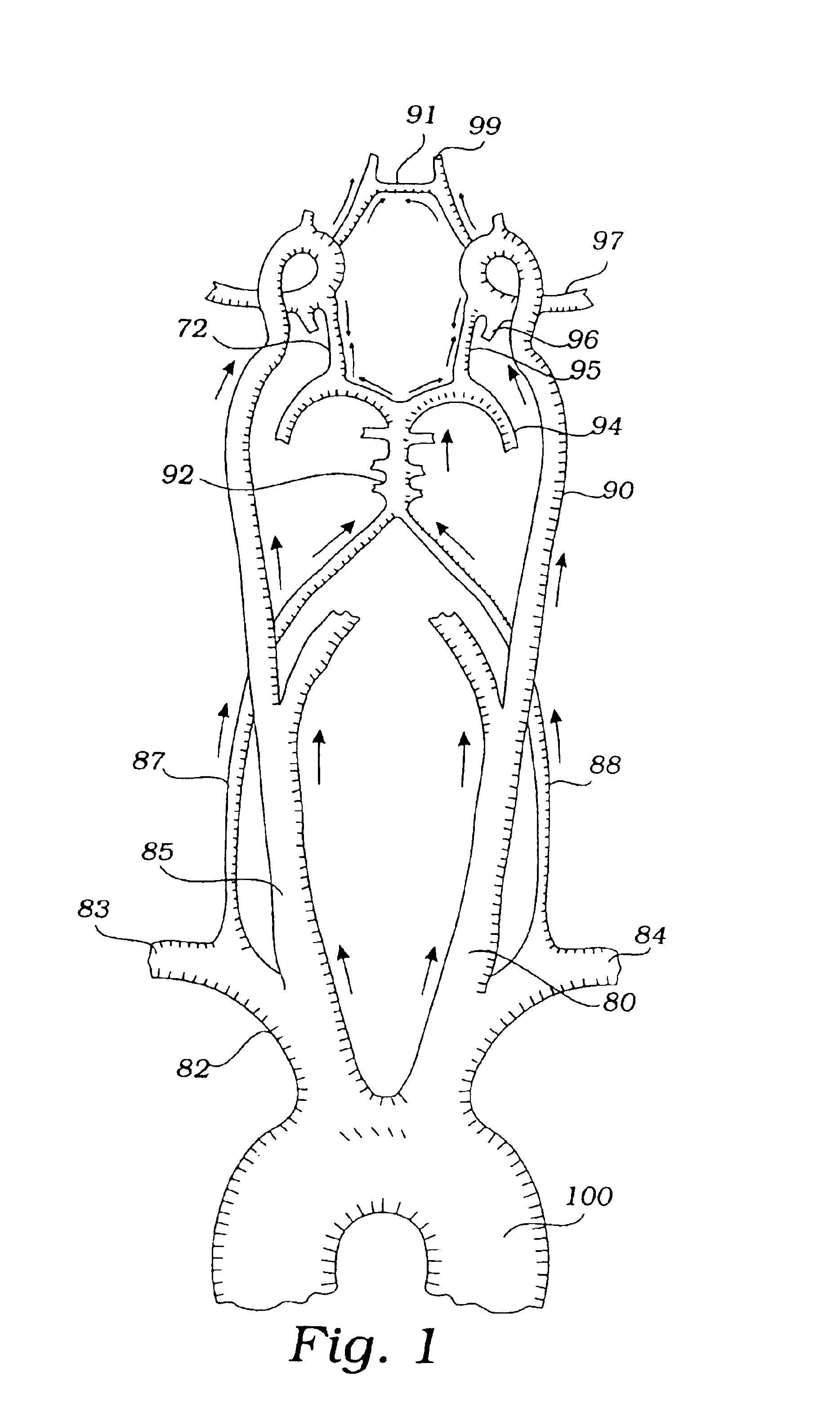 Devices and methods for preventing distal embolization using flow reversal by partial occlusion of the brachiocephalic artery