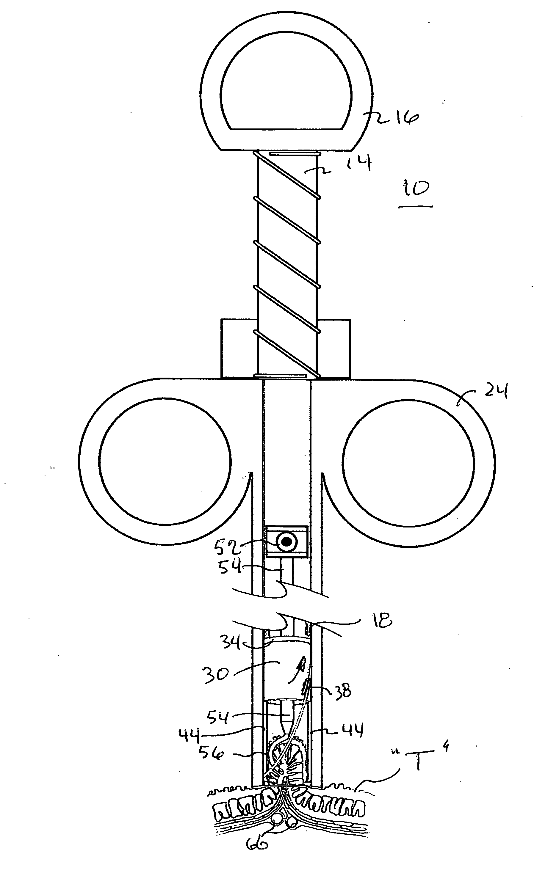 Apparatus and method of safe placement of bulking materials for gastroscopic vagus nerve bulking to reduce appetite and to effect weight loss