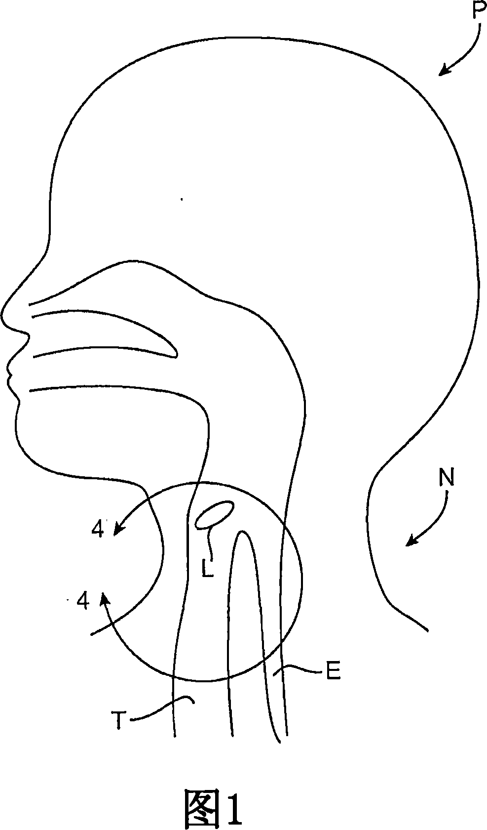 Methods and systems for tracheal access and ventilation