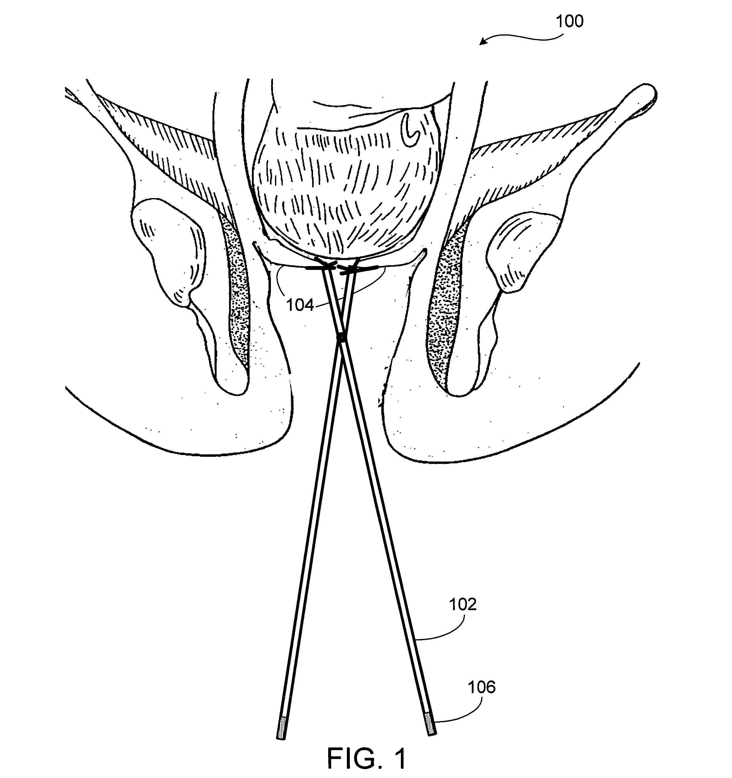 Apparatus and method for detection of cervical dilation during labor