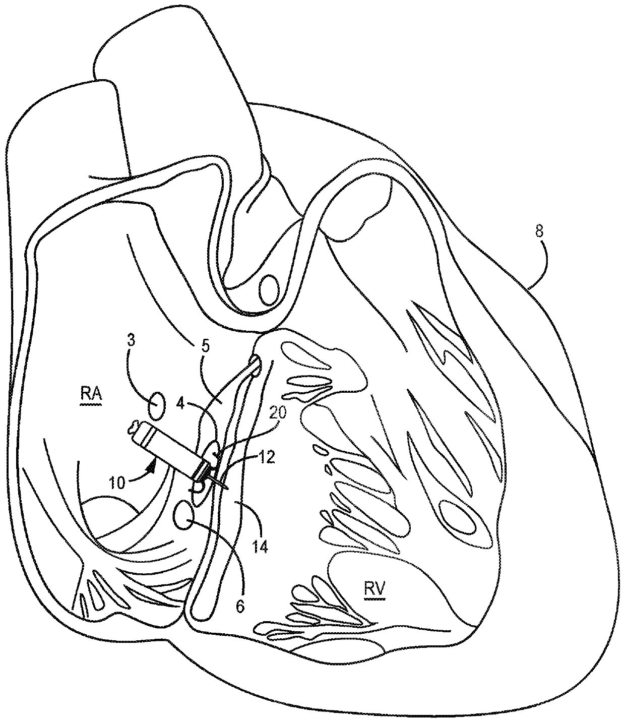 Electrodes for intra-cardiac pacemaker