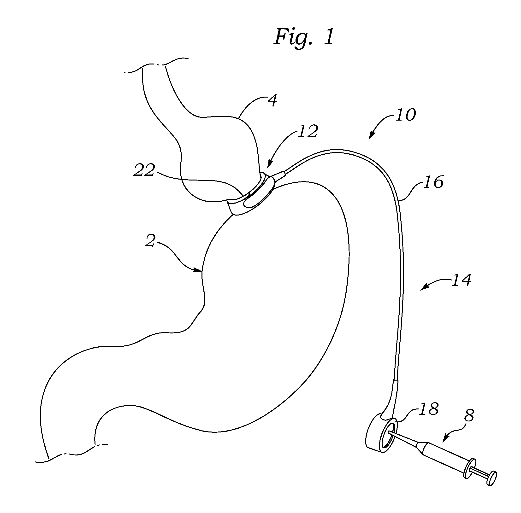 Laparoscopic Gastric Band With Active Agents