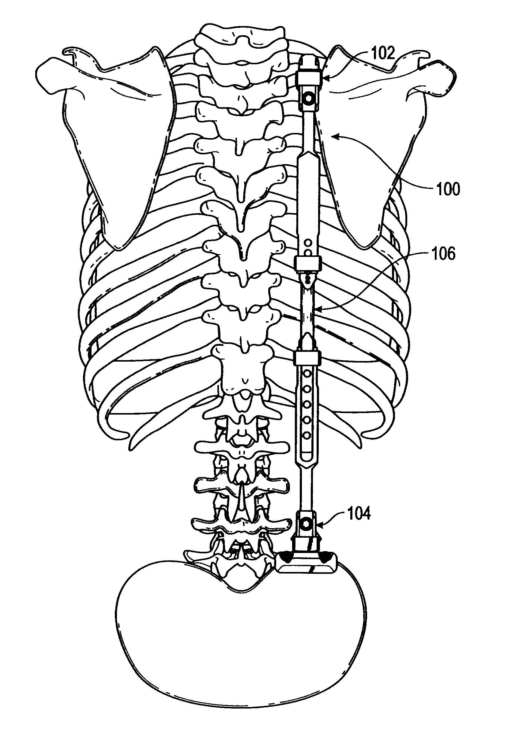 Bone support apparatus