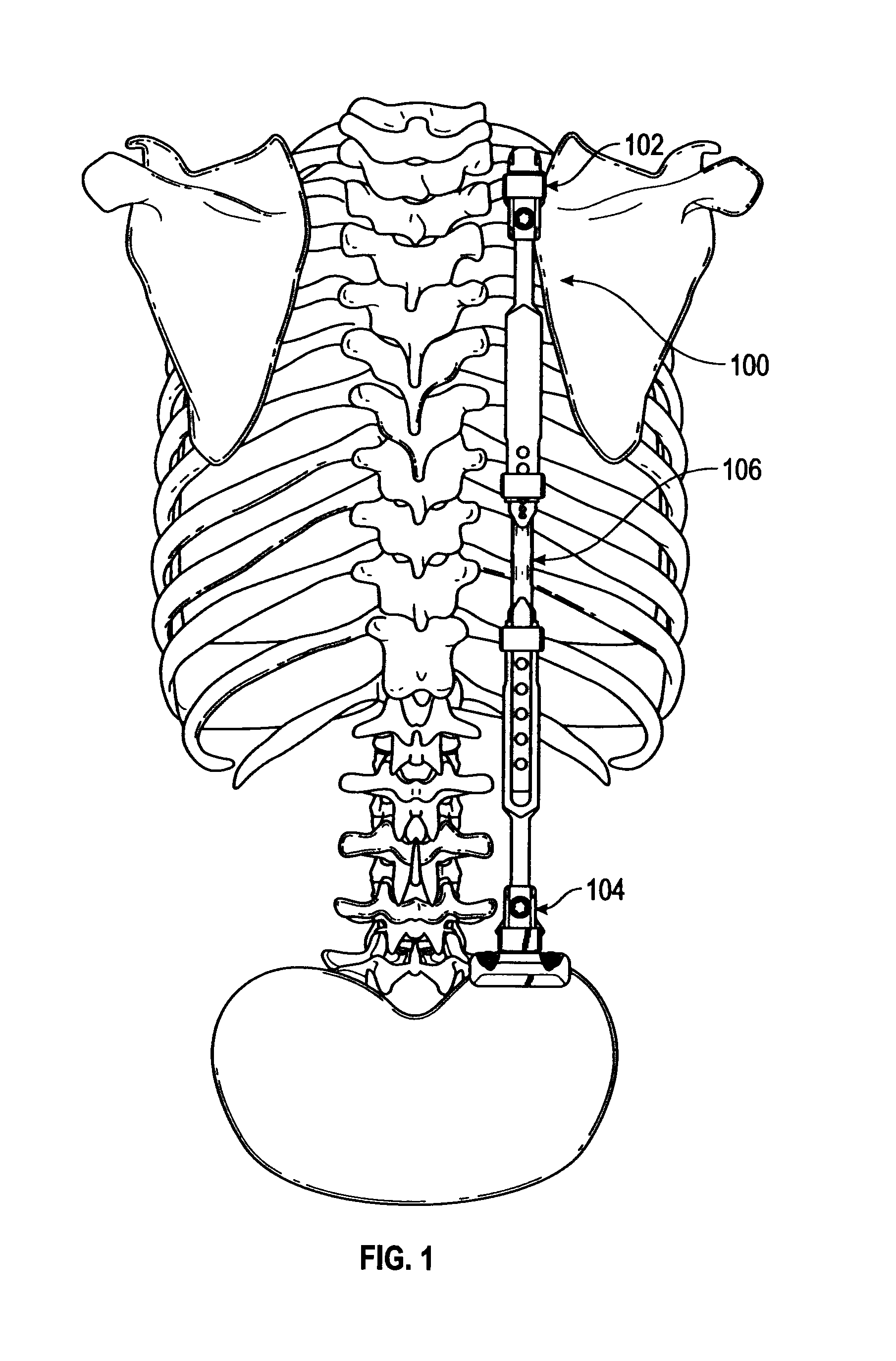 Bone support apparatus