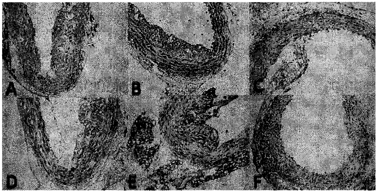 Traditional Chinese medicine composition, medicine containing traditional Chinese medicine composition, preparation method and application thereof