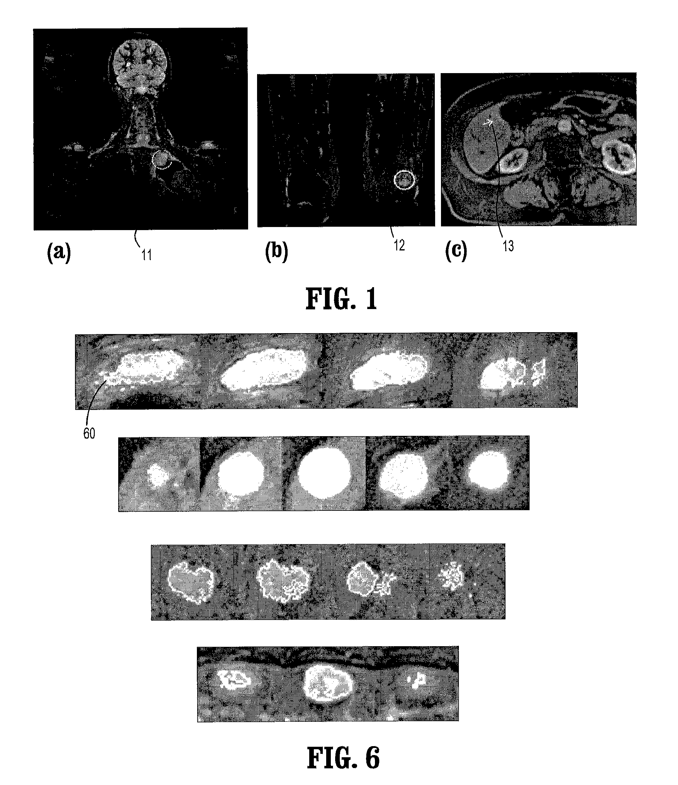 System and method for lesion segmentation in whole body magnetic resonance images