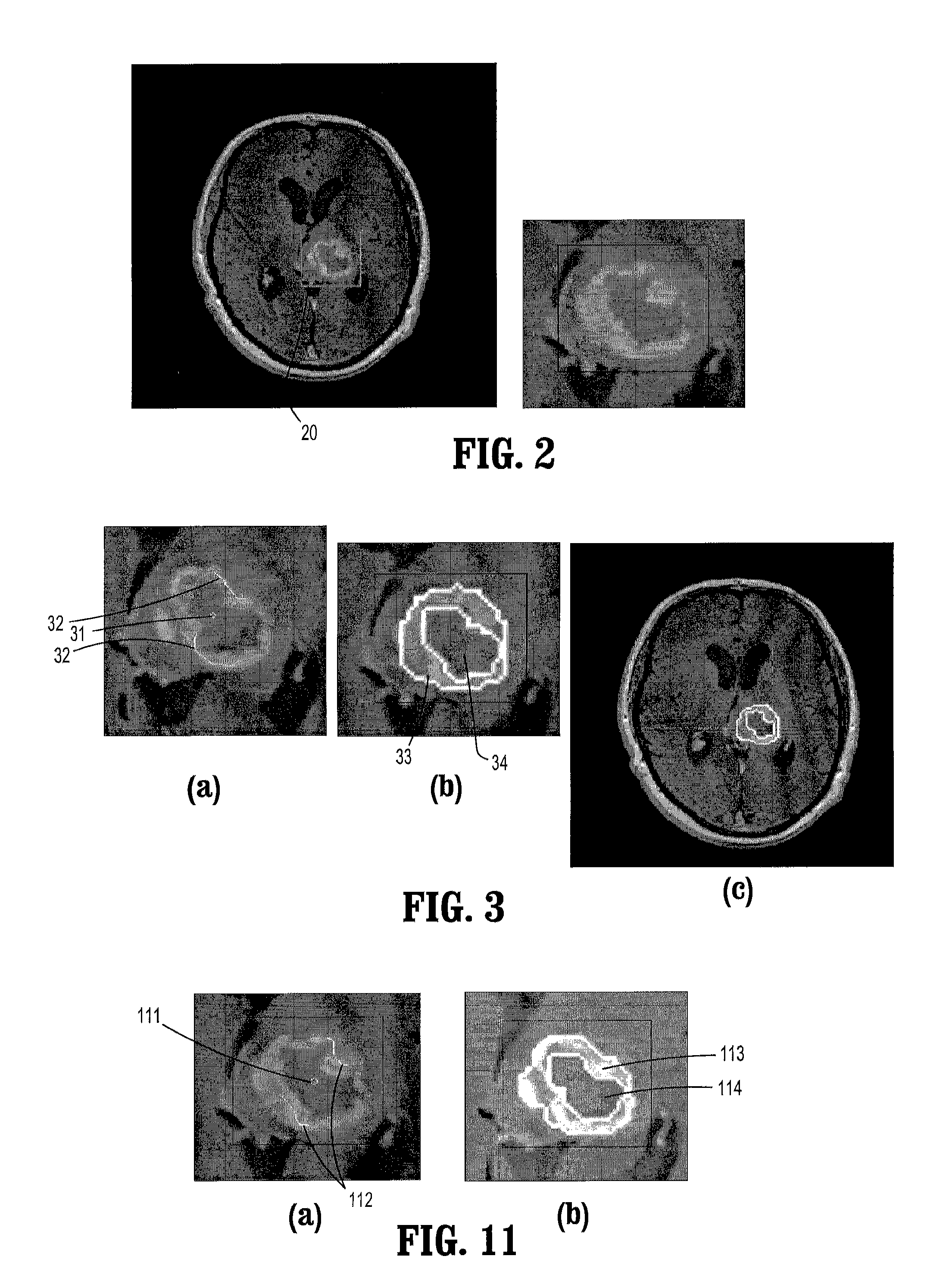 System and method for lesion segmentation in whole body magnetic resonance images