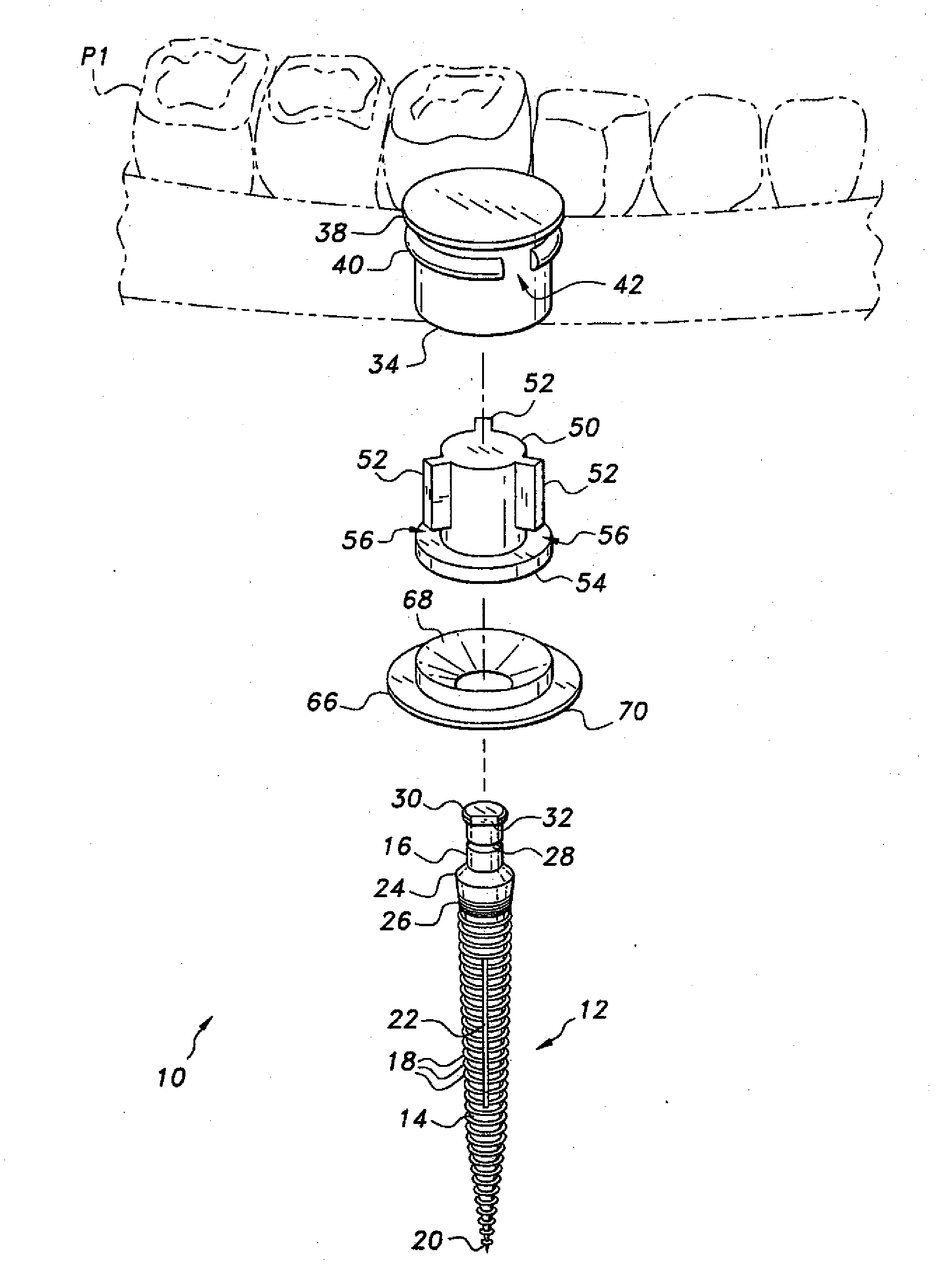 Dental implant system