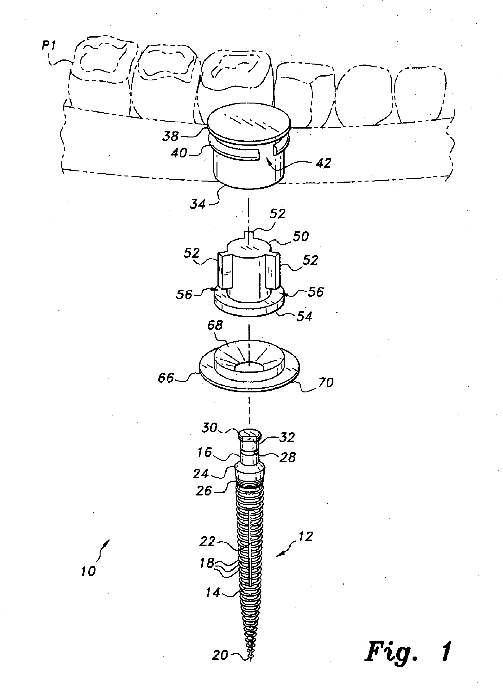 Dental implant system