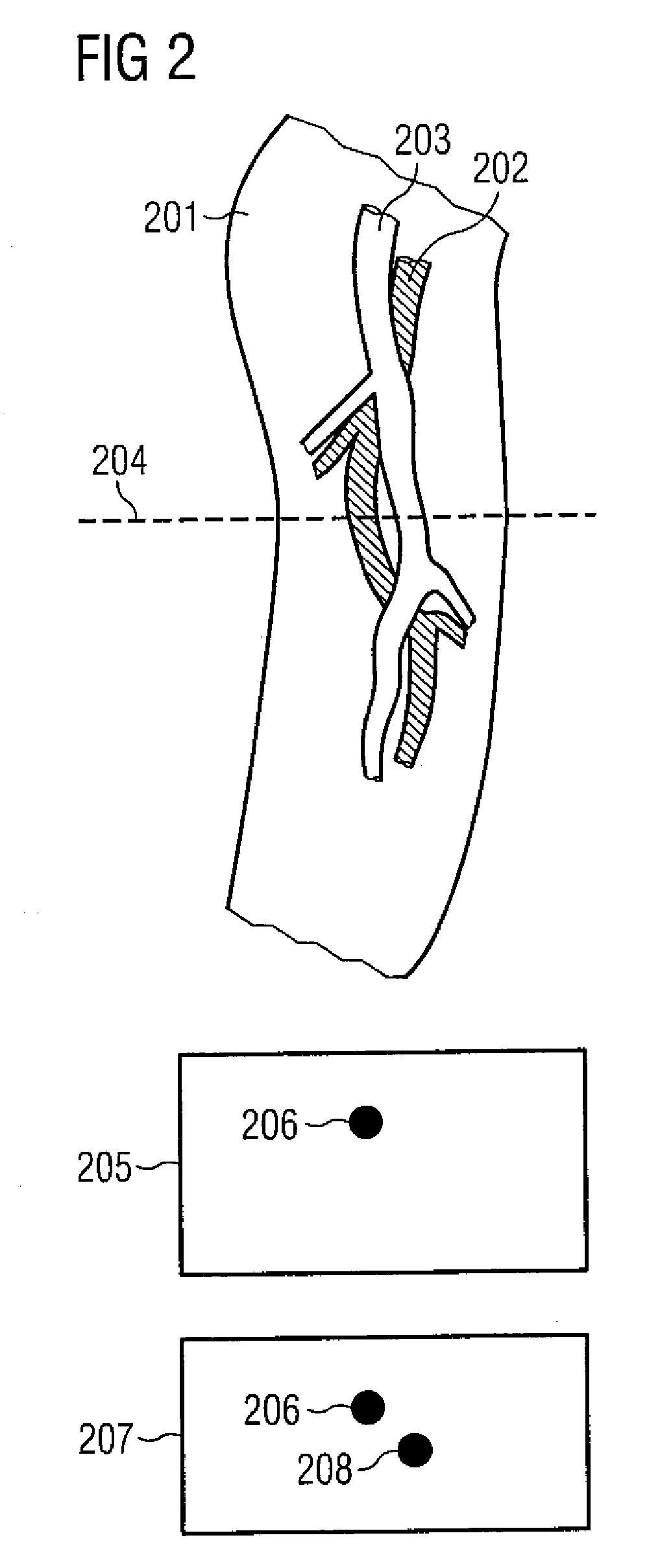 Angiographic method and apparatus allowing identification of contrast agent propagation