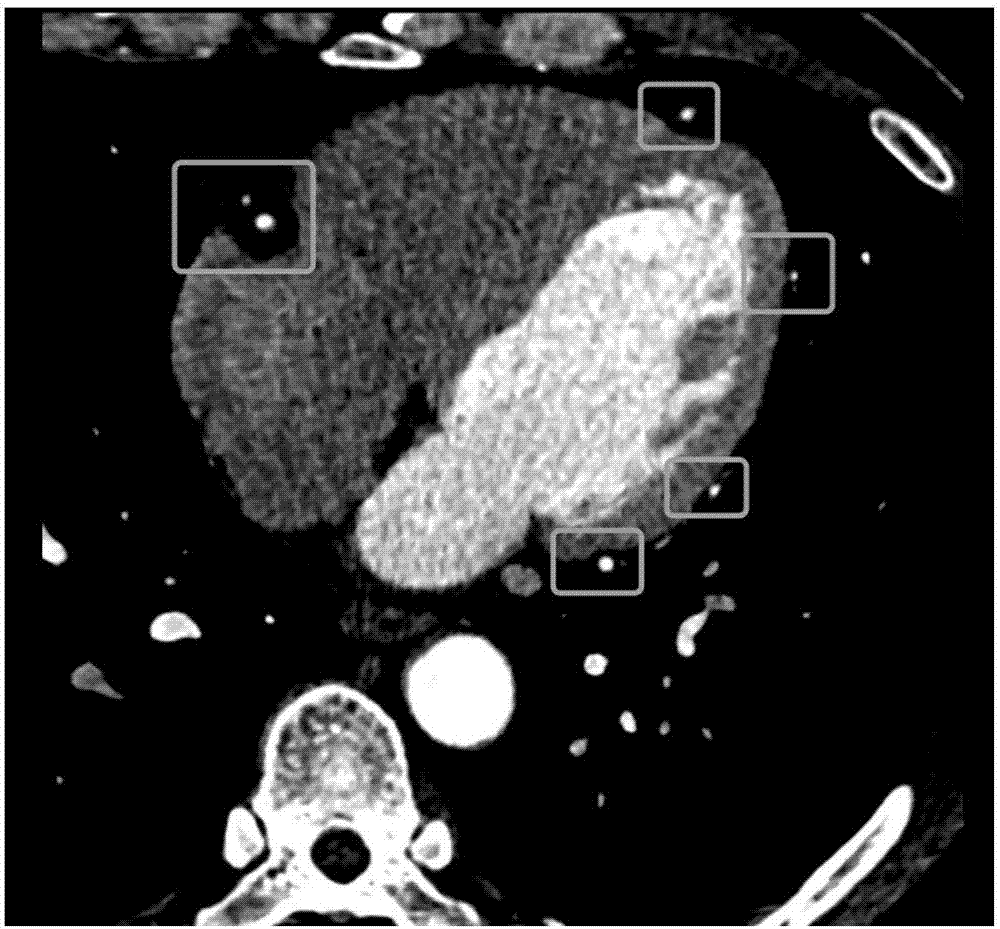 Deep learning neural network cascade model-based human heart coronary artery extraction method