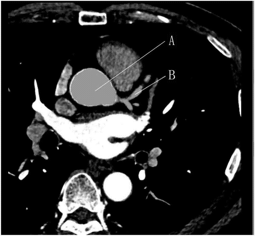 Deep learning neural network cascade model-based human heart coronary artery extraction method