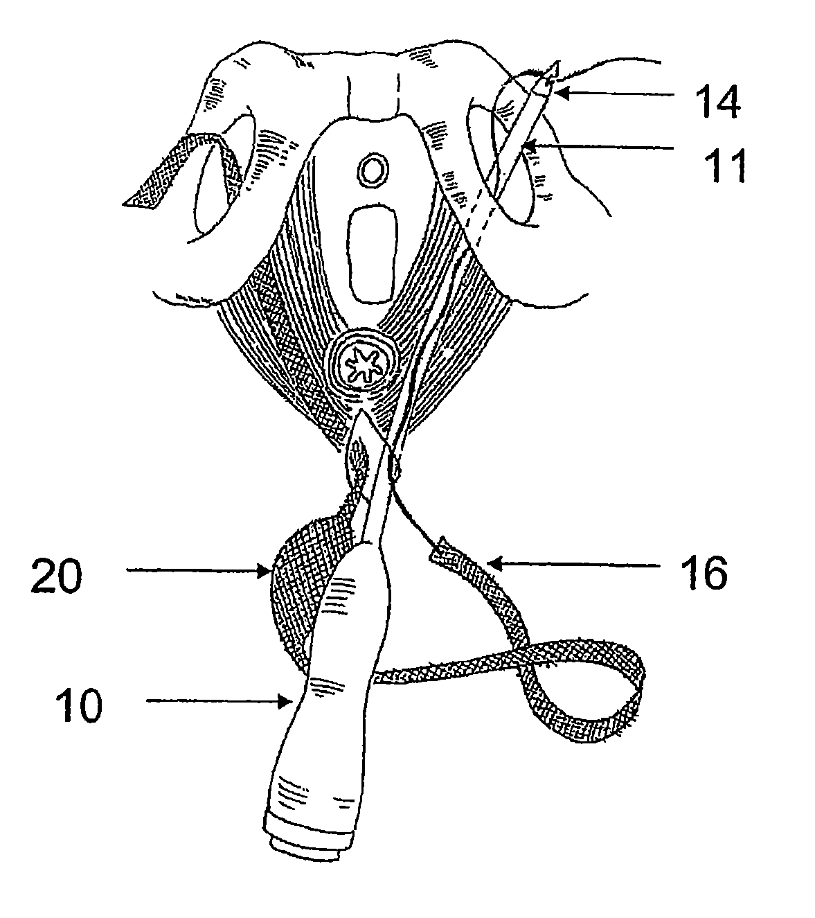 System and Method for Treatment of Anal Incontinence and Pelvic Organ Prolapse