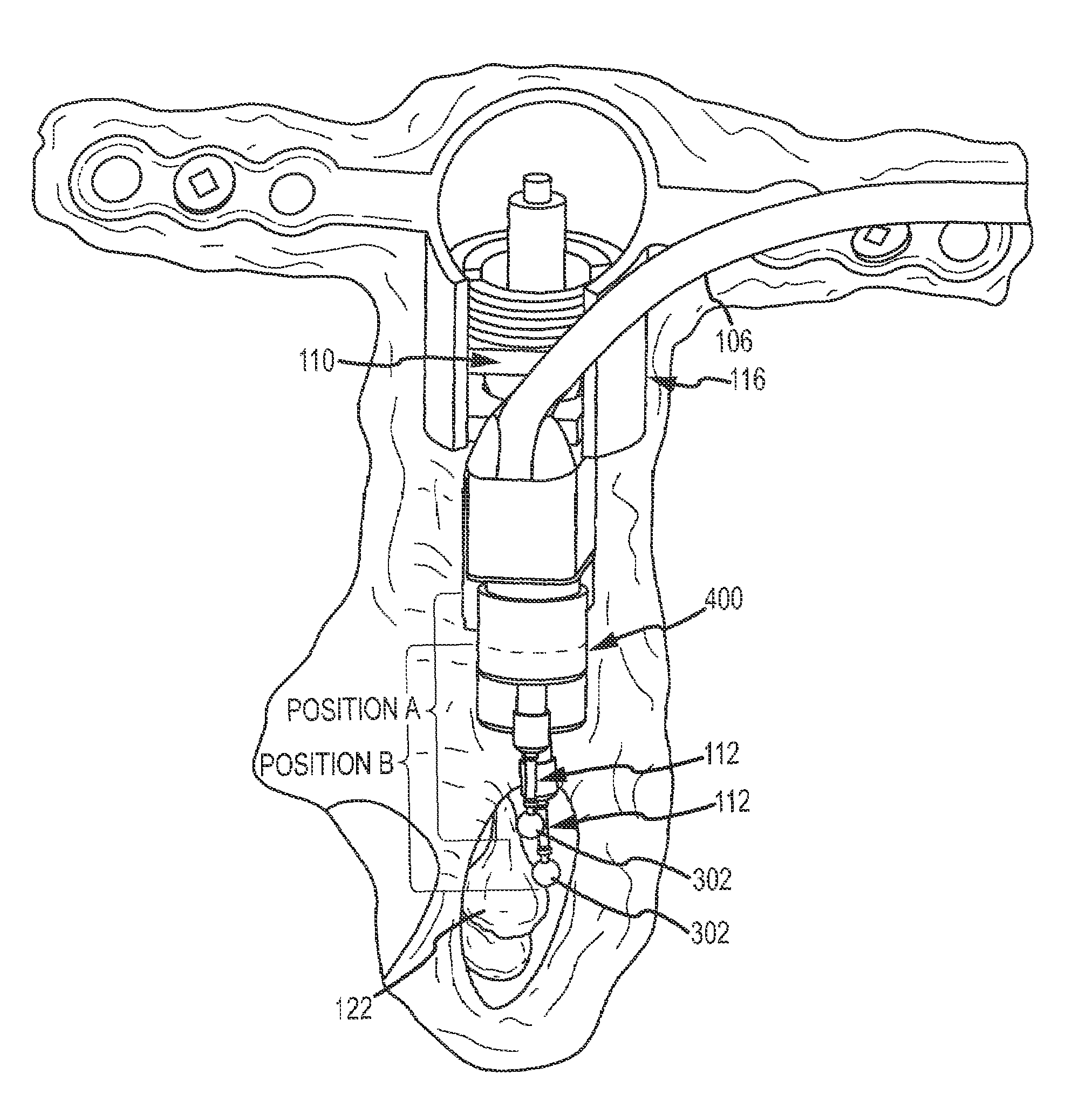 Lateral coupling of an implantable hearing aid actuator to an auditory component