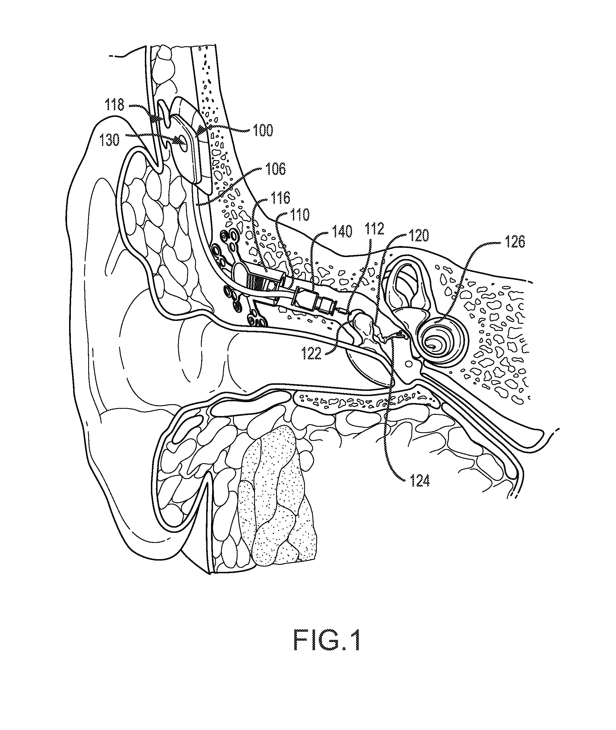 Lateral coupling of an implantable hearing aid actuator to an auditory component