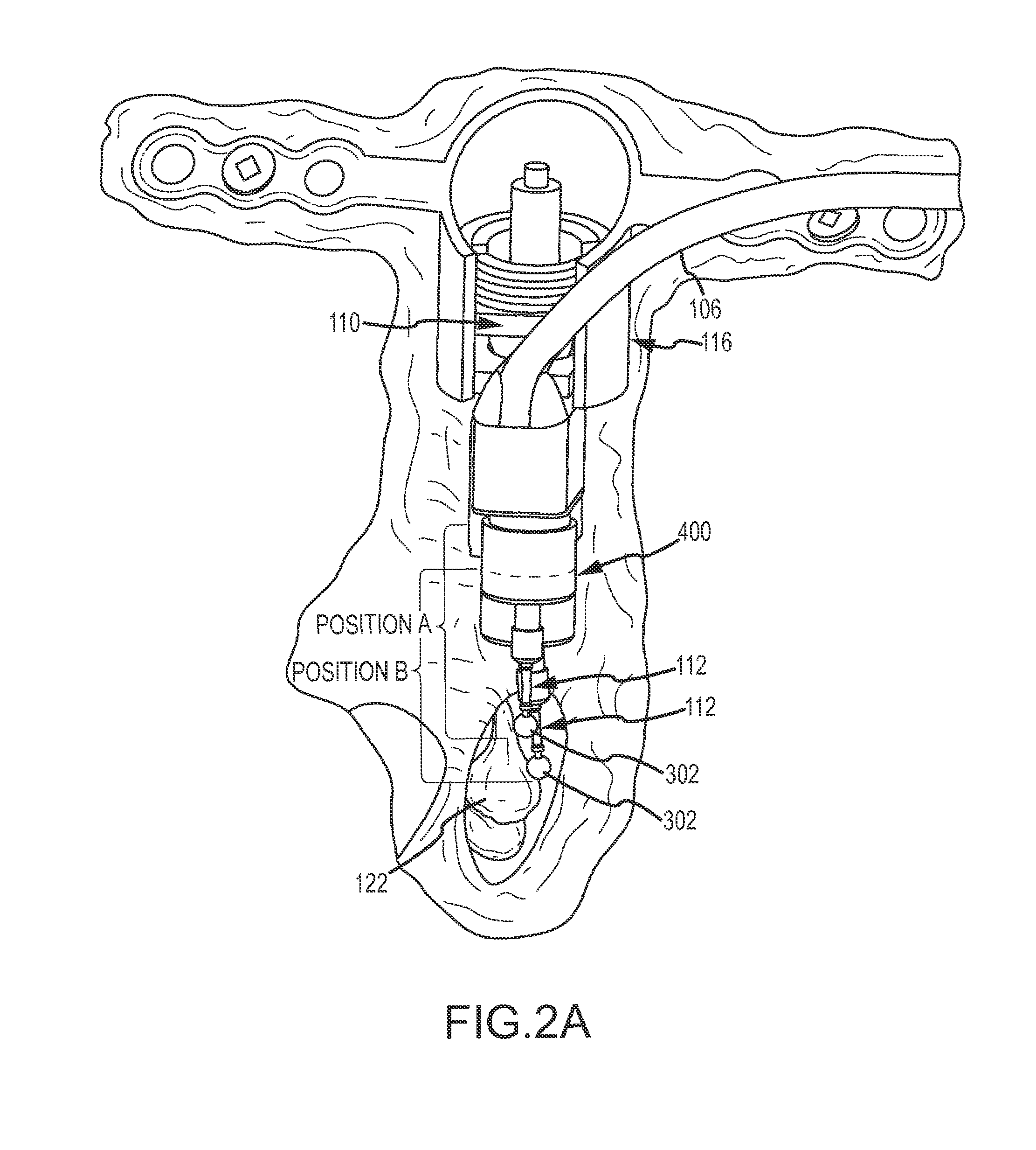 Lateral coupling of an implantable hearing aid actuator to an auditory component