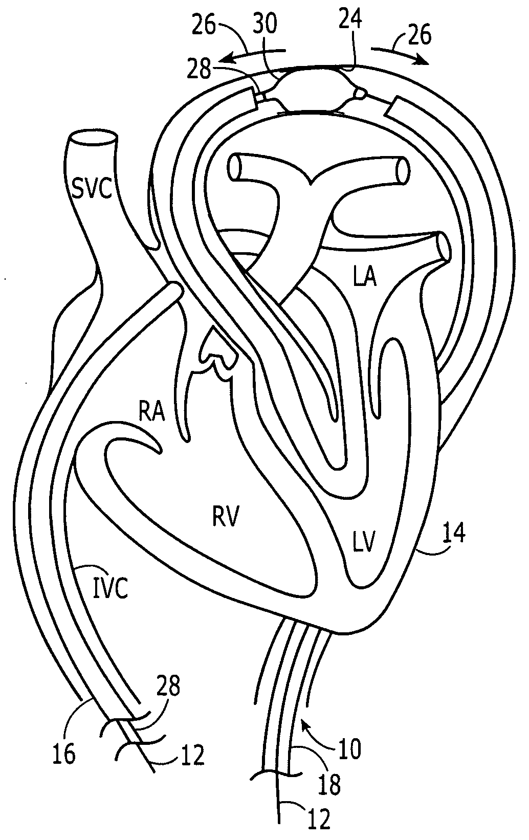 Separable sheath and method for insertion of a medical device into a bodily vessel using a separable sheath
