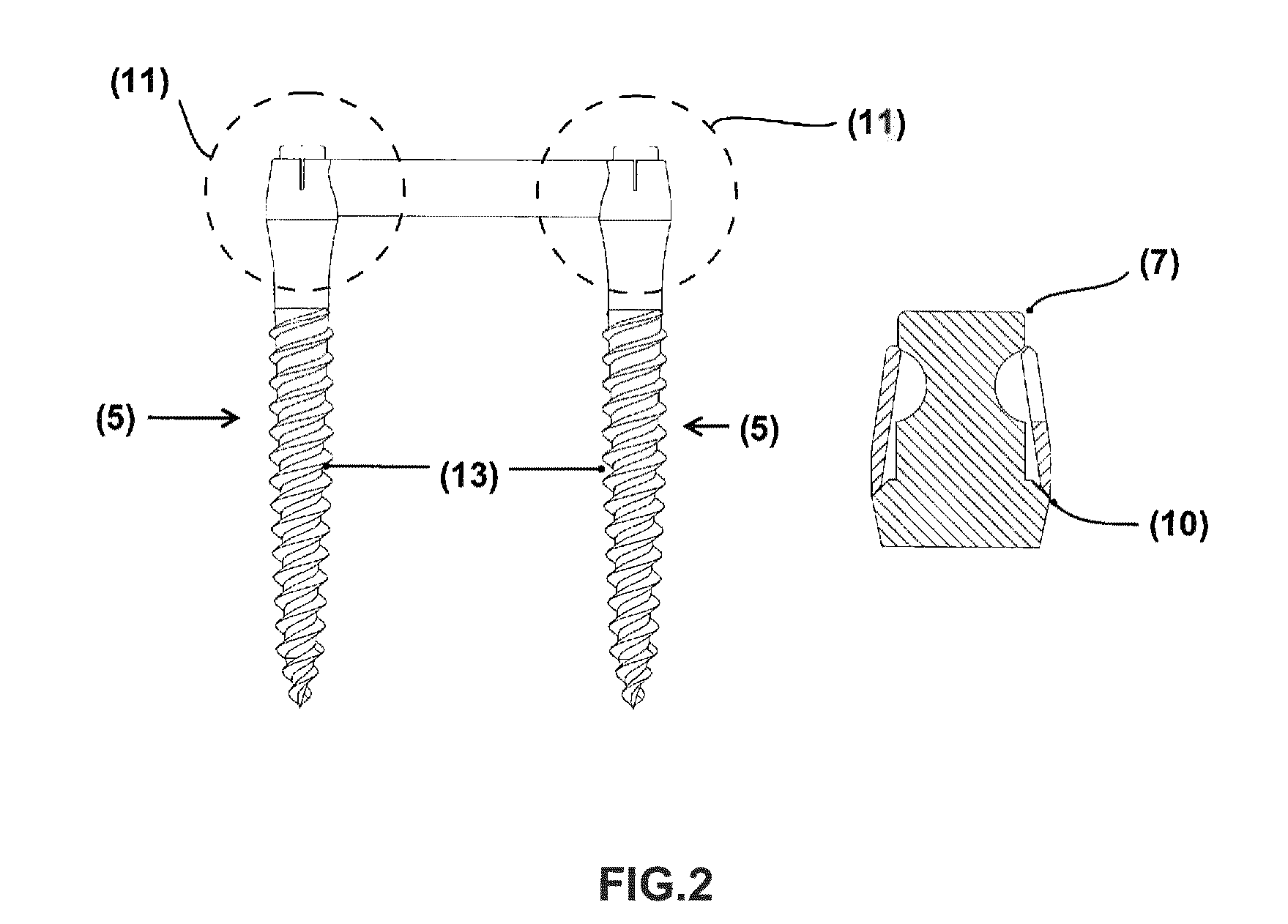 Prosthetic retention system for edentulous patients consisting of a prefabricated bar and two implants